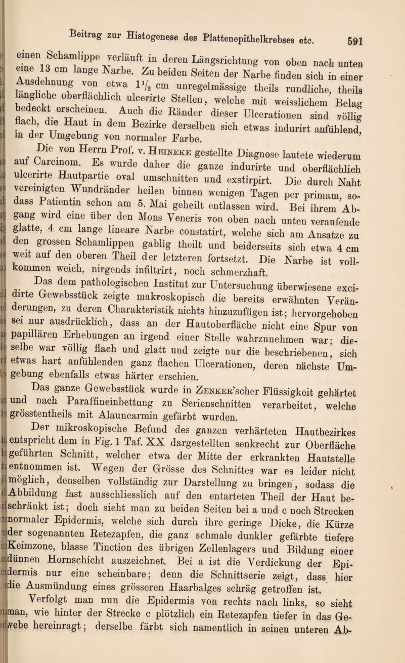 J S°“PPe verlauft in deren Langsrichtung yon oben nach unten ; T A l °m Dge Narbe' ZU b6ide“ Seiten der Narbe finden sich in einer 1 Wl-V'T fl°D, ,6tra 11/2 Cm “reg^massige theils rundliche, theils 1 oberflacbllcb ulcenrte Stellen, welche mit weisslichem Belag 1 Sl'ie°kr if?611' Auh die Rander dieser Ulcerationen sind yollig ^ . ’ d'® Haut m dem Bezirke derselben sicb etwas indurirt anfUhlend n in der Umgebung von normaler Farbe. Die von Herrn Prof. y. Heineke gestellte Diagnose lautete wiederum I auf Carcinom Es wurde daher die ganze indurirte nnd oberfiachlieh 4 ulcenrte Hautpartie oval umschnitten nnd exstirpirt. Die durch Naht i vereimgten Wundrander heilen binnen wenigen Tagen per primam, so¬ il dass Patientm schon am 5. Mai geheilt entlassen wird. Bei ihrem Ab- iS gang wird eme iiber den Mons Veneris von oben nach unten veraufende ! fatt6’ 4 Cm ,lmeare Narbe constatirt, welche sich am Ansatze zu ) den grossen Schamlippen gablig theilt und beiderseits sich etwa 4 cm 1? weit auf den oberen Theil der letzteren fortsetzt. Die Narbe ist voll- 53 kommen weich, nirgends infiltrirt, noch schmerzhaft. | , d®m Patbologischen Institut zur Untersuchung iiberwiesene exci- irte Gewebsstiick zeigte makroskopisch die bereits erwahnten Yeran- | eran£eib zu deren Charakteristik nicbts binzuzufiigen ist; kervorgehoben :e sei nur ausdriicklich, dass an der Hautoberflache nicbt eine Spur von I PaPinaren Erhebungen an irgend einer Stelle wahrzunehmen war; die- k selbe war vollig flach und glatt und zeigte nur die beschriebenen, sich JJ etwas ^arfc anfuhlenden ganz flachen Ulcerationen, deren nachste Um- gebung ebenfalls etwas harter erschien. Das ganze Gewebsstiick wurde in ZENKEn’scher Fliissigkeit gehartet | und nach Paraffineinbettung zu Serienschnitten verarbeitet, welche j| grosstentheils mit Alauncarmin gefarbt wurden. Der mikroskopische Befund des ganzen verharteten Hautbezirkes k entspricht dem in Pig. 1 Taf. XX dargestellten senkrecht zur Oberflache kgefuhrten Schnitt, welcher etwa der Mitte der erkrankten Hautstelle Jentnommen ist. Wegen der Grosse des Schnittes war es leider nicht omoglich, denselben vollstandig zur Darstellung zu bringen, sodass die c( Abbildung fast ausschliesslich auf den entarteten Theil der Haut be¬ ll schrankt ist; doch sieht man zu beiden Seiten bei a und c noch Strecken xinormaler Epidermis, welche sich durch ihre geringe Dicke, die Kiirze nder sogenannten Retezapfen, die ganz schmale dunkler gefarbte tiefere iKeimzone, blasse Tinction des ubrigen Zellenlagers und Bildung einer xdiinnen Hornschicht auszeichnet. Bei a ist die Verdickung der Epi- mdermis nur eine scheinbare; denn die Schnittserie zeigt, dass hier die Ausmundung eines grosseren Haarbalges schrag getroffen ist. ; Yerfolgt man nun die Epidermis von rechts nach links, so sieht l^an, wie hinter der Strecke c plotzlich ein Retezapfen tiefer in das Ge- dvebe hereinragt; derselbe farbt sich namentlich in seinen unteren Ab-