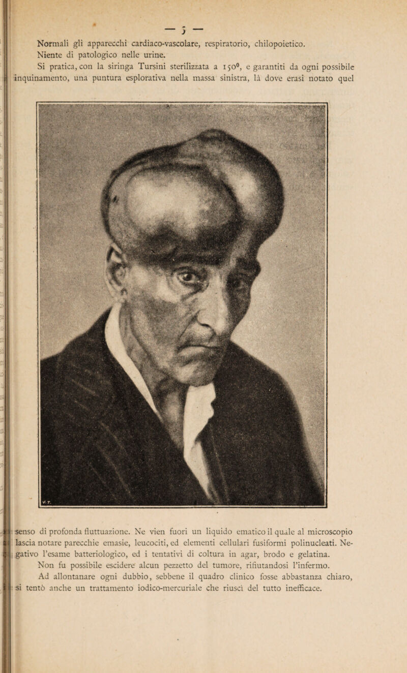 * j Normali gli apparecchi cardiaco-vascolare, respiratorio, chilopoietico. Niente di patologico nelle urine. Si praticatoti la siringa Tursini sterilizzata a 1500, e garantiti da ogni possibile inquinamento, una puntura esplorativa nella massa sinistra, là dove erasi notato quel | senso di profonda fluttuazione. Ne vien fuori un liquido ematico il quale al microscopio lascia notare parecchie emasie, leucociti, ed elementi cellulari fusiformi polinucleati. Ne- I gativo l’esame batteriologico, ed i tentativi di coltura in agar, brodo e gelatina. Non fu possibile escidere alcun pezzetto del tumore, rifiutandosi l’infermo. Ad allontanare ogni dubbio, sebbene il quadro clinico fosse abbastanza chiaro, II si tentò anche un trattamento iodico-mercuriale che riusci del tutto inefficace.