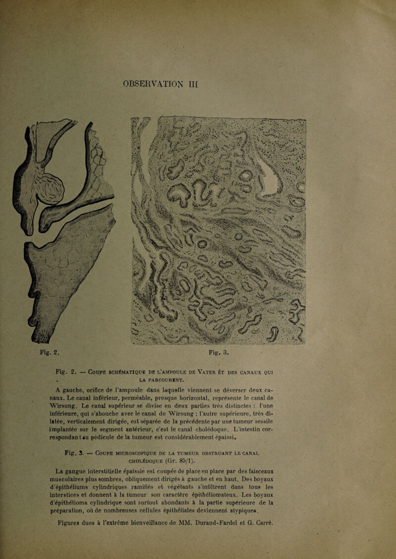 Fig. 2. Fig. 2. — Coupe schématique de l’ampoule de Vater èt des canaux qui . LA PARCOURENT. A gauche, orifice de l’ampoule dans laquelle viennent se déverser deux ca¬ naux. Le canal inférieur, perméable, presque horizontal, représente le canal de Wirsung. Le canal supe’rieur se divise en deux parties très distinctes : l’une inférieure, qui s’abouche avec le canal de Wirsung ; l'autre supérieure, très di¬ latée, verticalement dirigée, est séparée de la précédente par une tumeur sessile implantée sur le segment antérieur, c’est le canal cholédoque. L'intestin cor¬ respondant au pédicule de la tumeur est considérablement épaissi. Fig. 3. — Coupe microscopique de la tumeur obstruant le canal cholédoque (Gr. 85/1). La gangue interstitielle épaissie est coupée de place en place par des faisceaux musculaires plus sombres, obliquement dirigés à gauche et en haut. Des boyaux d’épithéliums cylindriques ramifiés et végétants s’infiltrent dans tous les interstices et donnent à la tumeur son caractère épithéliomateux. Les boyaux d’épithélioma cylindrique sont surtout abondants à la partie supérieure de la préparation, où de nombreuses cellules épithéliales deviennent atypiques. Figures dues à l’extrcme bienveillance de MM. Durand-Fardel et G. Carré.