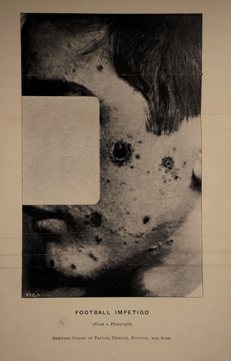 FOOTBALL IMPETIGO [From a Photograph), Shewing Stages of Papule, Vesicle, Pustule, and Scab.