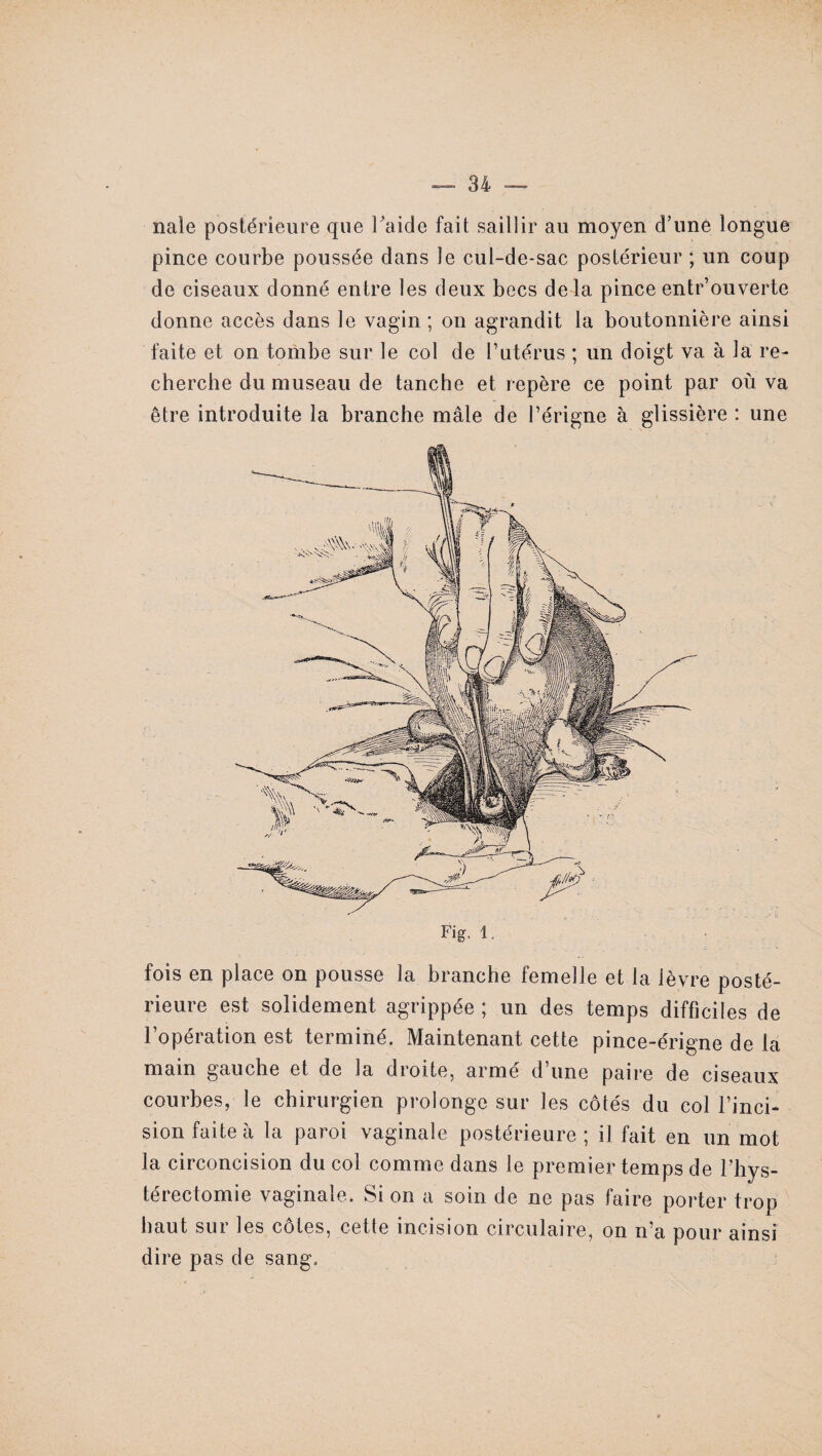 nale postérieure que raide fait saillir au moyen d’une longue pince courbe poussée dans le cul-de-sac postérieur ; un coup de ciseaux donné entre les deux becs de là pince entrouverte donne accès dans le vagin ; on agrandit la boutonnière ainsi faite et on tombe sur le col de l’utérus ; un doigt va à la re¬ cherche du museau de tanche et repère ce point par où va être introduite la branche mâle de Périgne à glissière : une fois en place on pousse la branche femelle et la lèvre posté¬ rieure est solidement agrippée ; un des temps difficiles de l’opération est terminé. Maintenant cette pince-érigne de la main gauche et de la droite, armé d’une paire de ciseaux courbes, le chirurgien prolonge sur les côtés du col l’inci¬ sion faite à la paroi vaginale postérieure ; il fait en un mot la circoncision du col comme dans le premier temps de l’hys- térectomie vaginale. Si on a soin de ne pas faire porter trop haut sur les côtes, cette incision circulaire, on n’a pour ainsi dire pas de sang.