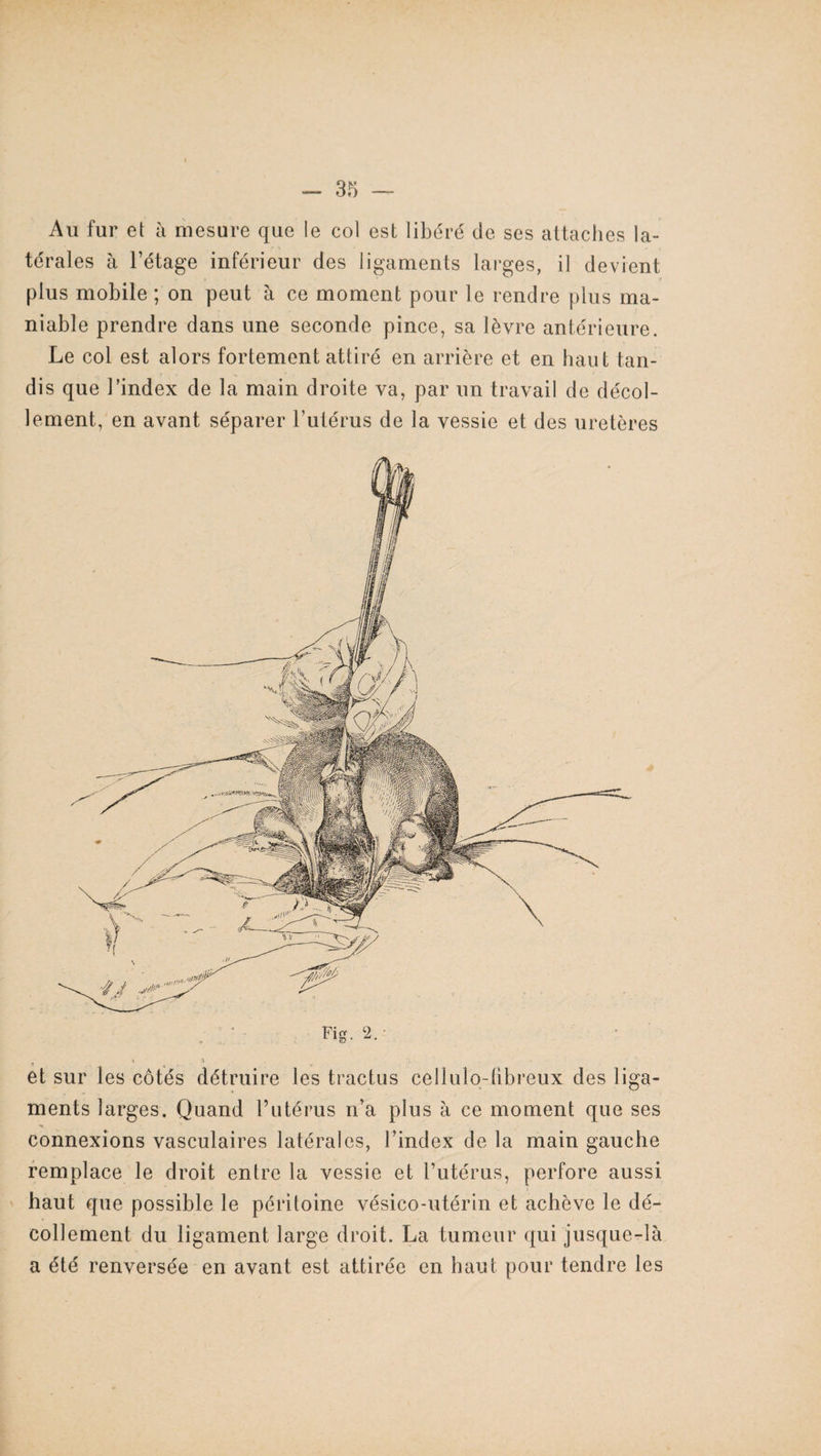 Au fur et à mesure que le col est libéré de ses attaches la¬ térales à l’étage inférieur des ligaments larges, il devient plus mobile ; on peut à ce moment pour le rendre plus ma¬ niable prendre dans une seconde pince, sa lèvre antérieure. Le col est alors fortement attiré en arrière et en haut tan¬ dis que l’index de la main droite va, par un travail de décol¬ lement, en avant séparer l’utérus de la vessie et des uretères Fig. 2. et sur les côtés détruire les tractus cellulo-tibreux des liga¬ ments larges. Quand l’utérus n’a plus à ce moment que ses connexions vasculaires latérales, l’index de la main gauche remplace le droit entre la vessie et l’utérus, perfore aussi haut que possible le péritoine vésico-utérin et achève le dé¬ collement du ligament large droit. La tumeur qui jusque-là a été renversée en avant est attirée en haut pour tendre les