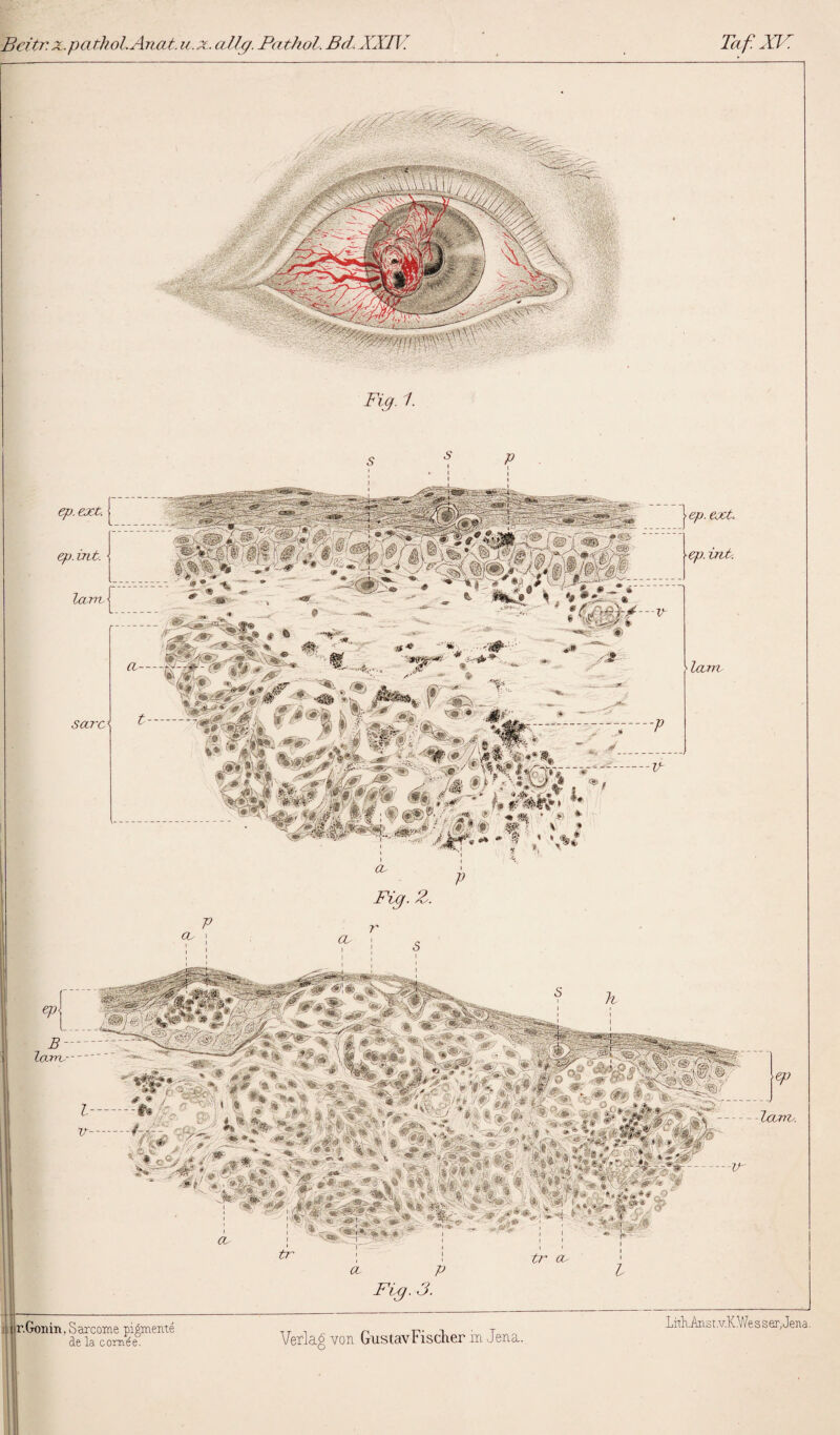 Beitr. x.pathol.Anat. u. z. allg. Pathol. Bd. XXIV Taf.XV. r.Gonin, Sarcome pigmenté de la cornée. Verlag von GustavFischer m Jena. Lith.Anst .v.K. We s ser, Jena. Fig. 1. tr oc rafiasK - ■-WmfV ep. extc. ep B- Icare-- ep. ejet. ep. bit. -v- -*>* - ^ - lœm Fig. 3. Fig. Z. r S