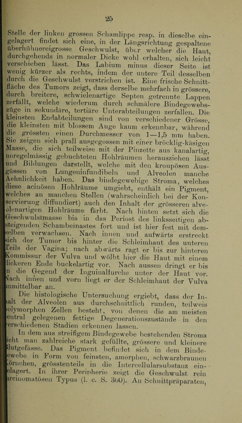 ‘25 Stelle der linken grossen Schamlippe resp. in dieselbe ein¬ gelagert findet sich eine, in der Längsrichtung gespaltene überhülmereigrosse Geschwulst, über welcher die Haut durchgehende in normaler Dicke wohl erhalten, sich leicht verschieben lässt. Das Labium minus dieser Seite ist wenig kürzer als rechts, indem der untere Teil desselben durch die Geschwulst verstrichen ist. Eine frische Schnitt¬ fläche des Tumors zeigt, dass derselbe mehrfach in grössere, durch breitere, schwielenartige Septen getrennte Lappen zerfällt, welche wiederum durch schmälere Bindegewebs- züge in sekundäre, tertiäre Unterabteilungen zerfallen. Die kleinsten Endabteilungen sind von verschiedener Grösse, die kleinsten mit blossem Auge kaum erkennbar, während die grössten einen Durchmesser von 1—1,5 mm haben. Sie zeigen sich prall ausgegossen mit einer bröcklig-käsigen Masse, die sich teilweise mit der Bmzette aus kanalartig, unregelmässig gebuchteten Hohlräumen herausziehen lässt und Bildungen darstellt, welche mit den kroupösen Aus¬ güssen von Lungeninfundibel n und Alveolen manche Aehnlichkeit haben. Das bindegewebige Stroma, welches diese acinösen Hohlräume umgiebt, enthält ein Pigment, welches an manchen Stellen (wahrscheinlich bei der Kon- fervierung diffundiert) auch den Inhalt der grösseren alve- o len artigen Hohlräume färbt. Nach hinten setzt sich die Geschwulslmasse bis in das Periost des linksseitigen ab¬ steigenden Schambeinastes fort und ist hier fest mit dem¬ selben verwachsen. Nach innen und aufwärts erstreckt kich der Tumor bis hinter die Schleimhaut des unteren Teils der \aginaj nach abwärts ragt er bis zur hinteren Kommissur der Vulva und wölbt hier die Haut mit einem pickeren Ende buckelartig vor. Nach aussen dringt er bis In die. Gegend der Inguinalfurche unter der Haut vor. Nach innen und vorn liegt er der Schleimhaut der Vulva hnmittelbar an. Die histologische Untersuchung ergiebt, dass der In¬ halt der Alveolen aus durchschnittlich runden, teilweis holymoiphen Hellen besteht, von denen die am meisten leutral gelegenen fettige Degenerationszustände in den rerschiedenen Stadien erkennen lassen. I In dem aus streifigem Bindegewebe bestehenden Stroma lieht man zahlreiche stark gefüllte, grössere und kleinere Idutgefässe. Das Pigment befindet sich in dem Binde¬ gewebe in Form von feinsten, amorphen, schwarzbraunen Körnchen, grösstenteils, in die Intercellularsubstanz ein- lelagei t. In ihrer Peripherie zeigt die Geschwulst rein