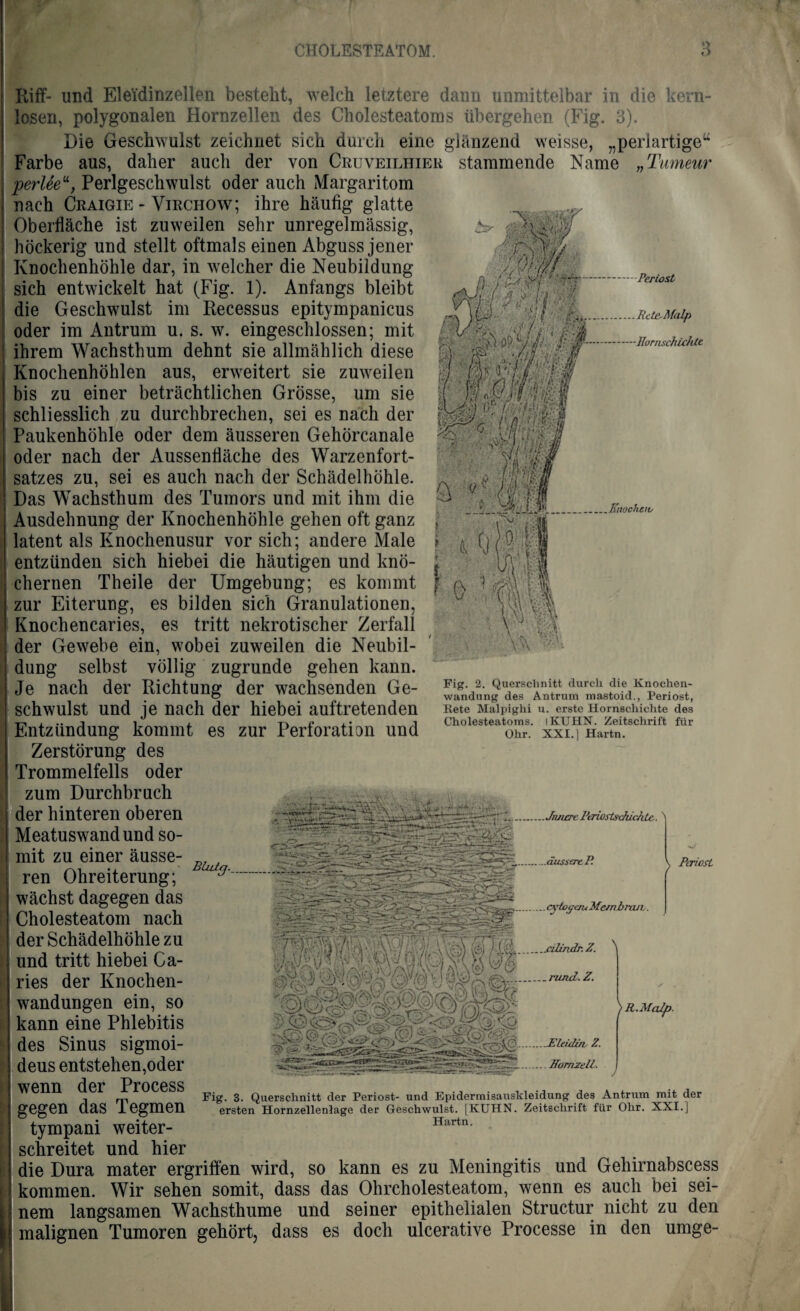 \ \‘<y i'-/' m' $\s M > l'j .. I Periost }C~'- f ' ' &.RcteMalp ': i/ K\ 4H i ■‘,0 V/>*-' * ’#'.llornschic/Ue ■)'. ff Riff- und Eleidinzellen besteht, welch letztere dann unmittelbar in die kern¬ losen, polygonalen Hornzellen des Cholesteatoms übergehen (Fig. 3). Die Geschwulst zeichnet sich durch eine glänzend weisse, „periartigeu Farbe aus, daher auch der von Cruveilhier stammende Name „Tmneur perlte“, Perlgeschwulst oder auch Margaritom nach Craigie - Virchow; ihre häufig glatte Oberfläche ist zuweilen sehr unregelmässig, höckerig und stellt oftmals einen Abguss jener Knochenhöhle dar, in welcher die Neubildung sich entwickelt hat (Fig. 1). Anfangs bleibt die Geschwulst im Recessus epitympanicus oder im Antrum u. s. w. eingeschlossen; mit ihrem Wachsthum dehnt sie allmählich diese Knochenhöhlen aus, erweitert sie zuweilen bis zu einer beträchtlichen Grösse, um sie schliesslich zu durchbrechen, sei es nach der Paukenhöhle oder dem äusseren GehÖrcanale oder nach der Aussenfläche des Warzenfort¬ satzes zu, sei es auch nach der Schädelhöhle. Das Wachsthum des Tumors und mit ihm die Ausdehnung der Knochenhöhle gehen oft ganz latent als Knochenusur vor sich; andere Male entzünden sich hiebei die häutigen und knö¬ chernen Theile der Umgebung; es kommt f a 1 f zur Eiterung, es bilden sich Granulationen, vy Knochencaries, es tritt nekrotischer Zerfall der Gewebe ein, wobei zuweilen die Neubil¬ dung selbst völlig zugrunde gehen kann. Je nach der Richtung der wachsenden Ge¬ schwulst und je nach der hiebei auftretenden Entzündung kommt es zur Perforation und Zerstörung des Trommelfells oder zum Durchbruch der hinteren oberen Meatuswand und so¬ mit zu einer äusse- i o m :va t ’ Fig. 2. Querschnitt durch die Knochen¬ wandung des Antrum mastoid., Periost, Rete Malpighi u. erste Hornschichte des Cholesteatoms. IKUHN. Zeitschrift für Ohr. XXI. 1 Hartn. ren Ohreiterung; Bb^ ~. ■ . % . ii . .•■‘5— .... —- .J/uurePeriortsJuchte. ...o' Z~rfj jr-U .jcdindr. Z. ^ \ PcriosL cyiogcru Membrauv. ) R.Mcdp. wächst dagegen das Cholesteatom nach der Schädelhöhle zu und tritt hiebei Ga- ries der Knochen¬ wandungen ein, so kann eine Phlebitis des Sinus sigmoi- deus entstehen,oder wenn der Process gegen das Tegmen tympani weiter¬ schreitet und hier die Dura mater ergriffen wird, so kann es zu Meningitis und Gehirnabscess kommen. Wir sehen somit, dass das Ohrcholesteatom, wenn es auch bei sei¬ nem langsamen Wachsthume und seiner epithelialen Structur nicht zu den malignen Tumoren gehört, dass es doch ulcerative Processe in den umge- _Eleiilin, Z. .ITornzell. J Fig. 3. Querschnitt der Periost- und Epidermisauskleidung des Antrum mit der ersten Hornzellenlage der Geschwulst. [KUHN. Zeitschrift für Ohr. XXI.] Hartn.