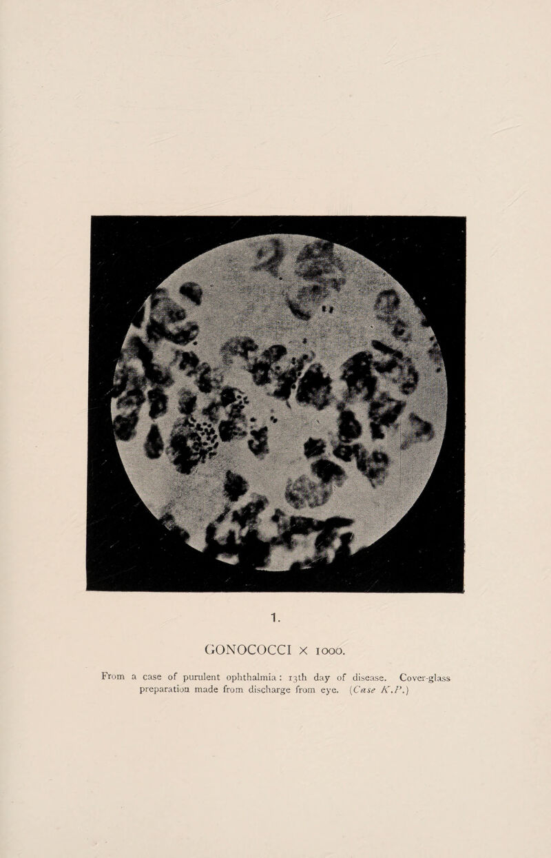 1. GONOCOCCI X iooo. From a case of purulent ophthalmia : 13th day of disease. Cover-glass preparation made from discharge from eye. [Case K.P.)