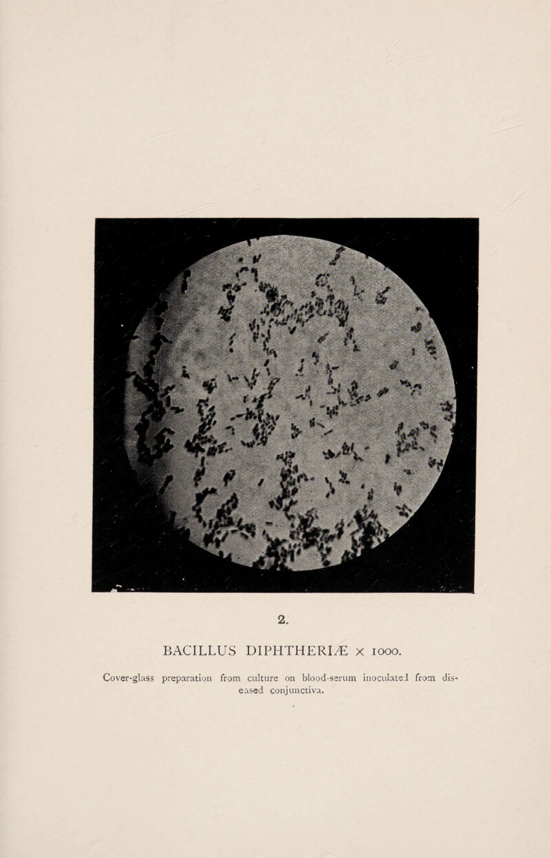 BACILLUS DIPHTHERIA x 1000. Cover-glass preparation from culture on blood-serum inoculated from dis eased conjunctiva.