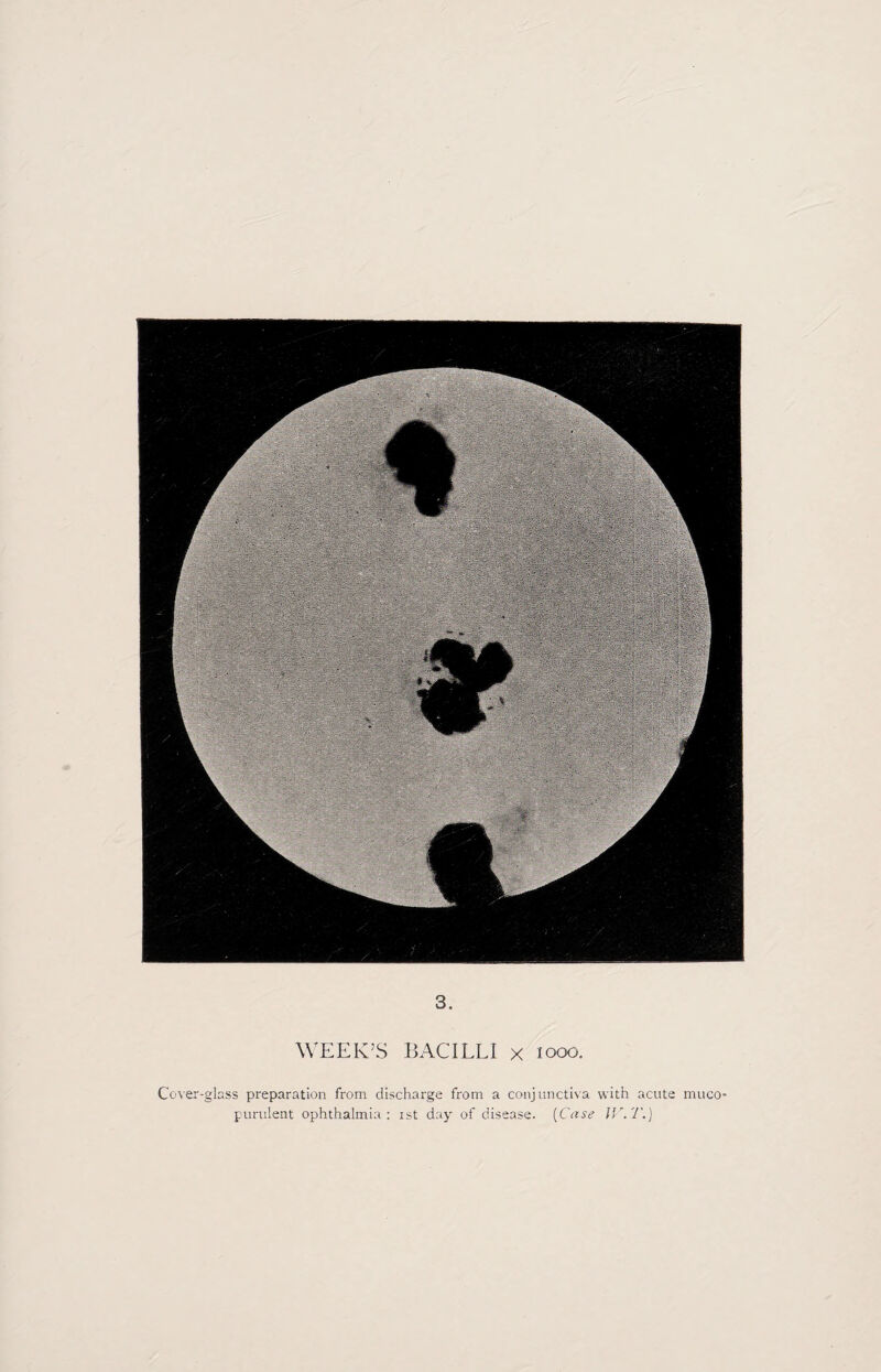 3. WEEK’S BACILLI x woo. Cover-glass preparation from discharge from a conjunctiva with acute muco¬