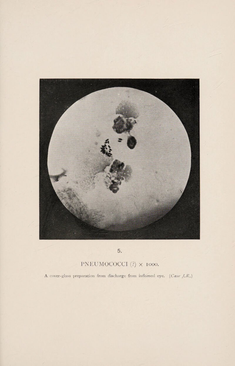 5. PNEUMOCOCCI (?) x 1000. A cover-glass preparation from discharge from inflamed eye, {Case J.R.)