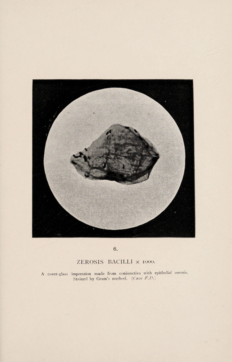 6. ZEROS IS BACILLI x 1000. A cover-glass impression made from conjunctiva with epithelial zerosis. Stained by Gram’s method. {Case F.D,