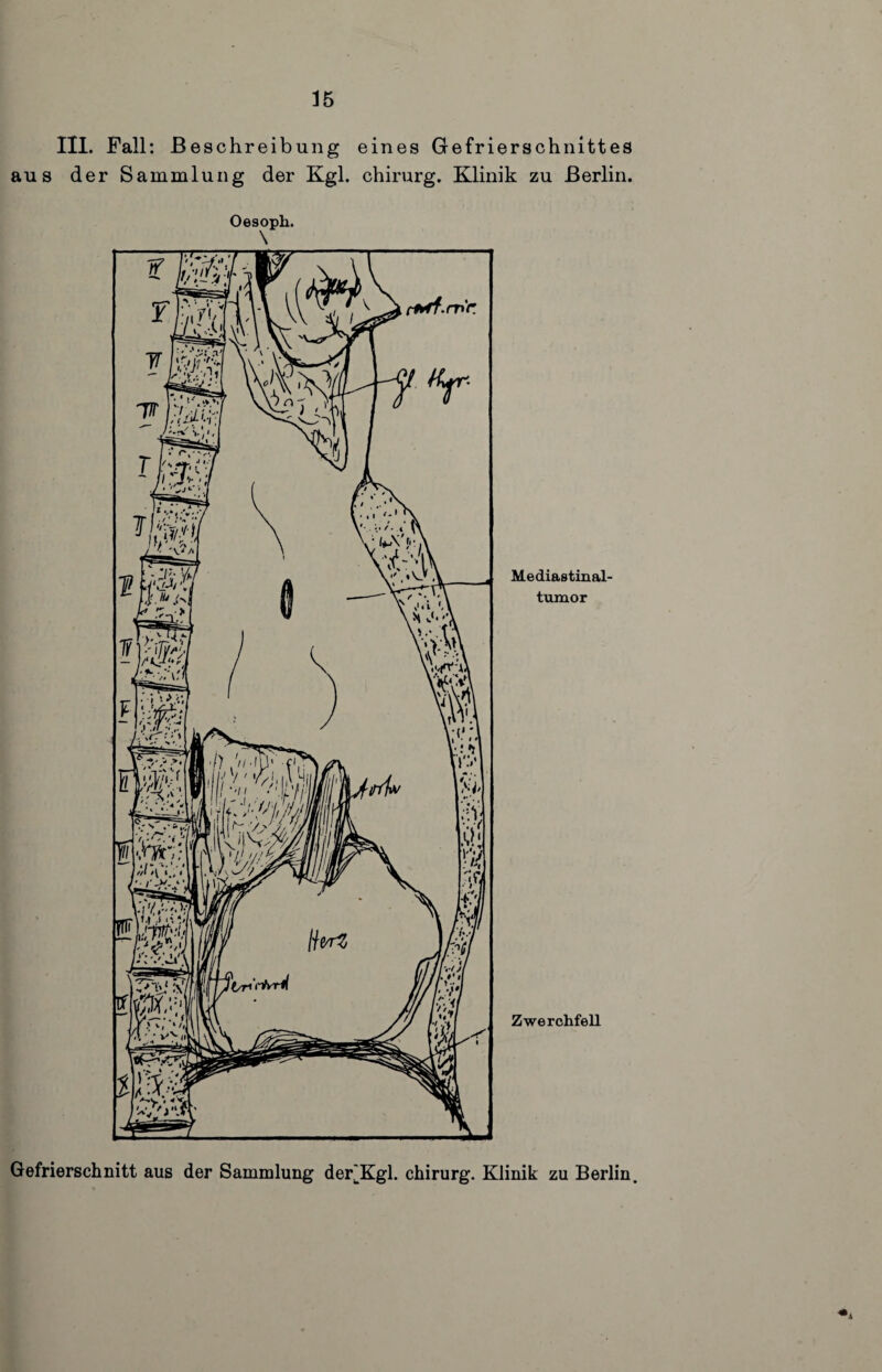 III. Fall: Beschreibung eines Gefrierschnittes aus der Sammlung der Kgl. chirurg. Klinik zu Berlin. Oesoph. \ Mediastinal¬ tumor Zwerchfell Gefrierschnitt aus der Sammlung der^Kgl. chirurg. Klinik zu Berlin.