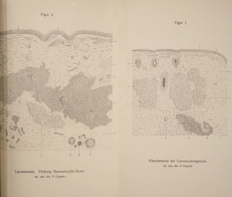 Figur 2 Lipodermoid. Färbung Haematoxylin-Eosin. ad. nat. del. P. Cappes . Figur 1 Fibrodermoid der Corneoscleralgrenze. ad. nat. del. P. Cappes.