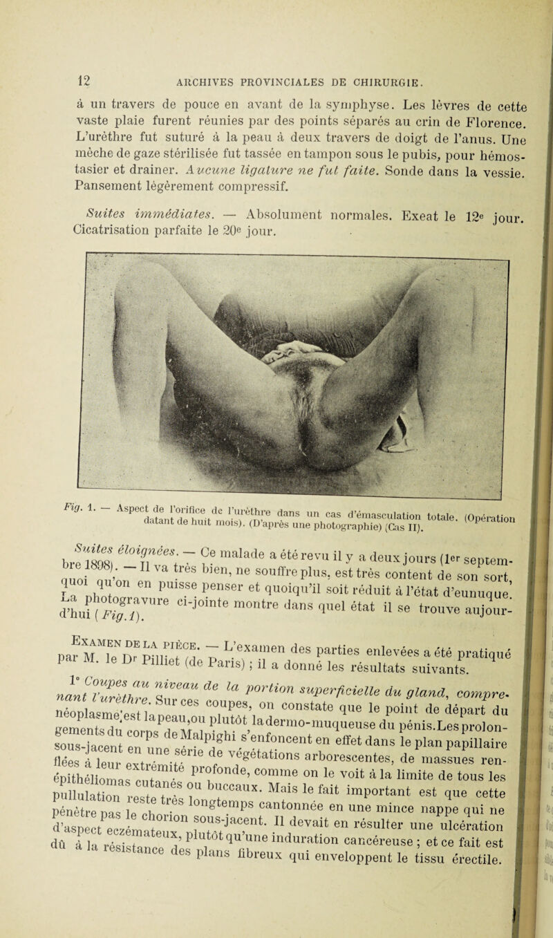 à un travers de pouce en avant de la symphyse. Les lèvres de cette vaste plaie furent réunies par des points séparés au crin de Florence. L’urèthre fut suturé à la peau à deux travers de doigt de l’anus. Une mèche de gaze stérilisée fut tassée en tampon sous le pubis, pour hémos- tasier et drainer. Aucune ligature ne fut faite. Sonde dans la vessie. Pansement légèrement compressif. Suites immédiates. — Absolument normales. Exeat le 12e jour# Cicatrisation parfaite le 20e jour. Fig. 1. A-- .strrsÆîissîss “• «*— | bre 189» ■ *pe raaIade a ete revu il y a deux jours (l<u septem- auoi ou on ! J6n’116 souffrePlus> esttrès content de son sort, f 0,1 en pulsse Penser et quoiqu’il soit réduit à l’état d’eunuque d’hu1 (S™” C1'J°mte m°ntre danS quel état ü se trouve aujour- pafrrC^rw!' 7 L’exainen des parties enlevées a été pratiqué par M. le D' Pilliet (de Paris) ; il a donné les résultats suivants. nantTZZhfe XT™ ** U POrtim su»erficielle ^ 9land, compre. neoplasmewt; TPe8’ 011 co,lstate que le point de départ du Kementsdn M plutot ladermo-muqueuse du pénis.Lesprolon- sous-iacent en PJghi 8«“foncent en effet dans le plan papillaire flées àleur e,tr etSene / végétations arborescentes, de massues ren- Sélîomas c rnf C°mme 011 le a >a ^ite de tous les pullulation reste t .-S T b“coaux' Mals le fait important est que cette pénètre nas le chn'eS °ng emps cantonnée en une mince nappe qui ne d’aspect ecimat !°S;,,‘cent- 11 deVait 611 résulter une ulcération dû à la résistance plu,tot qu’une induration cancéreuse ; et ce fait est ■ • ce des plans fibreux qui enveloppent le tissu érectile.