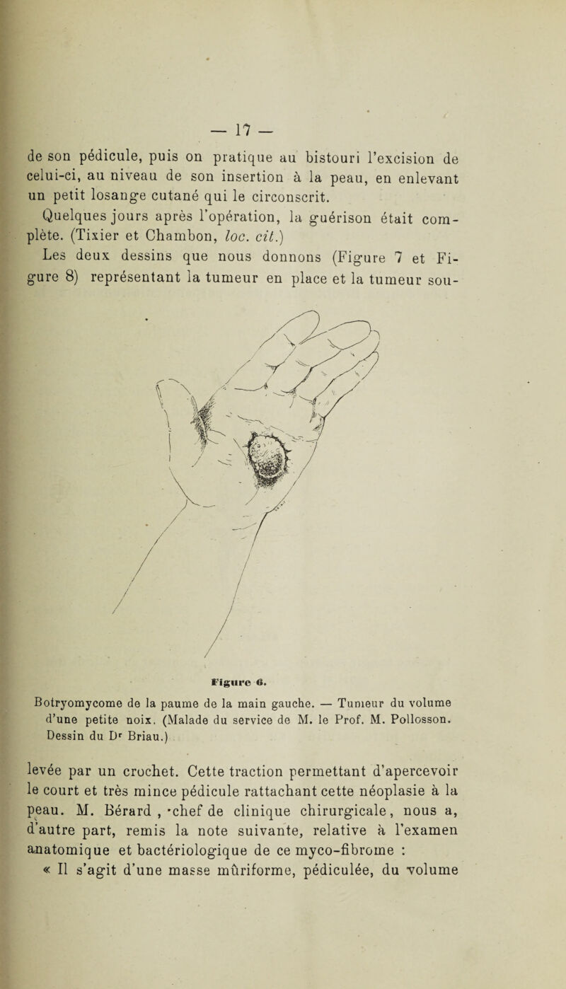 de son pédicule, puis on pratique au bistouri l’excision de celui-ci, au niveau de son insertion à la peau, en enlevant un petit losange cutané qui le circonscrit. Quelques jours après l’opération, la guérison était com¬ plète. (Tixier et Chambon, loc. cit.) Les deux dessins que nous donnons (Figure 7 et Fi¬ gure 8) représentant la tumeur en place et la tumeur sou- Figiirc 6. Botryomycome de la paume de la main gauche. — Tumeur du volume d’une petite noix. (Malade du service de M. le Prof. M. Pollosson. Dessin du Dr Briau.) levée par un crochet. Cette traction permettant d’apercevoir le court et très mince pédicule rattachant cette néoplasie à la peau. M. Bérard , *chef de clinique chirurgicale, nous a, d’autre part, remis la note suivante, relative à l’examen anatomique et bactériologique de ce myco-fibroine : « Il s’agit d’une masse mûriforme, pédiculée, du volume