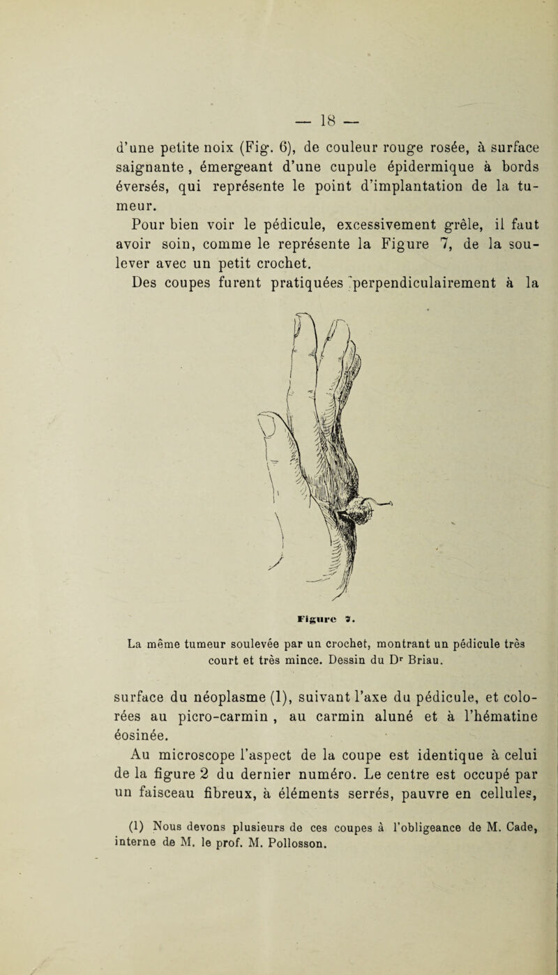 d’une petite noix (Fig*. 6), de couleur rouge rosée, à surface saignante , émergeant d’une cupule épidermique à bords éversés, qui représente le point d’implantation de la tu¬ meur. Pour bien voir le pédicule, excessivement grêle, il faut avoir soin, comme le représente la Figure 7, de la sou¬ lever avec un petit crochet. Des coupes furent pratiquées 'perpendiculairement à la La même tumeur soulevée par un crochet, montrant un pédicule très court et très mince. Dessin du Dr Briau. surface du néoplasme (1), suivant l’axe du pédicule, et colo¬ rées au picro-carmin , au carmin aluné et à l’hématine éosinée. Au microscope l’aspect de la coupe est identique à celui de la figure 2 du dernier numéro. Le centre est occupé par un faisceau fibreux, à éléments serrés, pauvre en cellules, (1) Nous devons plusieurs de ces coupes à l’obligeance de M. Cade, interne de M. le prof. M. Pollosson.