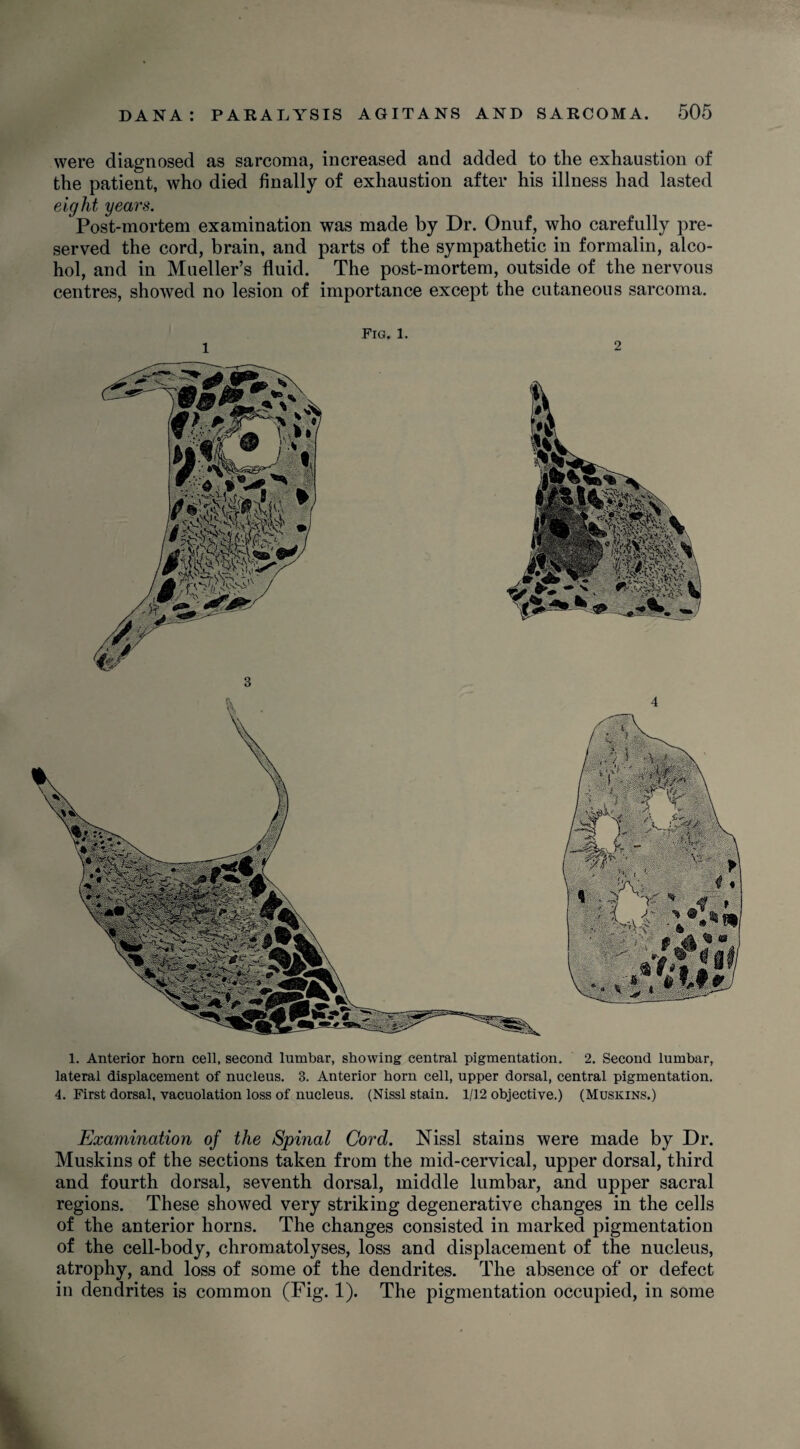 were diagnosed as sarcoma, increased and added to the exhaustion of the patient, who died finally of exhaustion after his illness had lasted eight years. Post-mortem examination was made by Dr. Onuf, who carefully pre¬ served the cord, brain, and parts of the sympathetic in formalin, alco¬ hol, and in Mueller’s fluid. The post-mortem, outside of the nervous centres, showed no lesion of importance except the cutaneous sarcoma. 1 Fig. 1. 2 1. Anterior horn cell, second lumbar, showing central pigmentation. 2. Second lumbar, lateral displacement of nucleus. 3. Anterior horn cell, upper dorsal, central pigmentation. 4. First dorsal, vacuolation loss of nucleus. (Nissl stain. 1/12 objective.) (Muskins.) Examination of the Spinal Cord. Nissl stains were made by Dr. Muskins of the sections taken from the mid-cervical, upper dorsal, third and fourth dorsal, seventh dorsal, middle lumbar, and upper sacral regions. These showed very striking degenerative changes in the cells of the anterior horns. The changes consisted in marked pigmentation of the cell-body, chromatolyses, loss and displacement of the nucleus, atrophy, and loss of some of the dendrites. The absence of or defect in dendrites is common (Fig. 1). The pigmentation occupied, in some