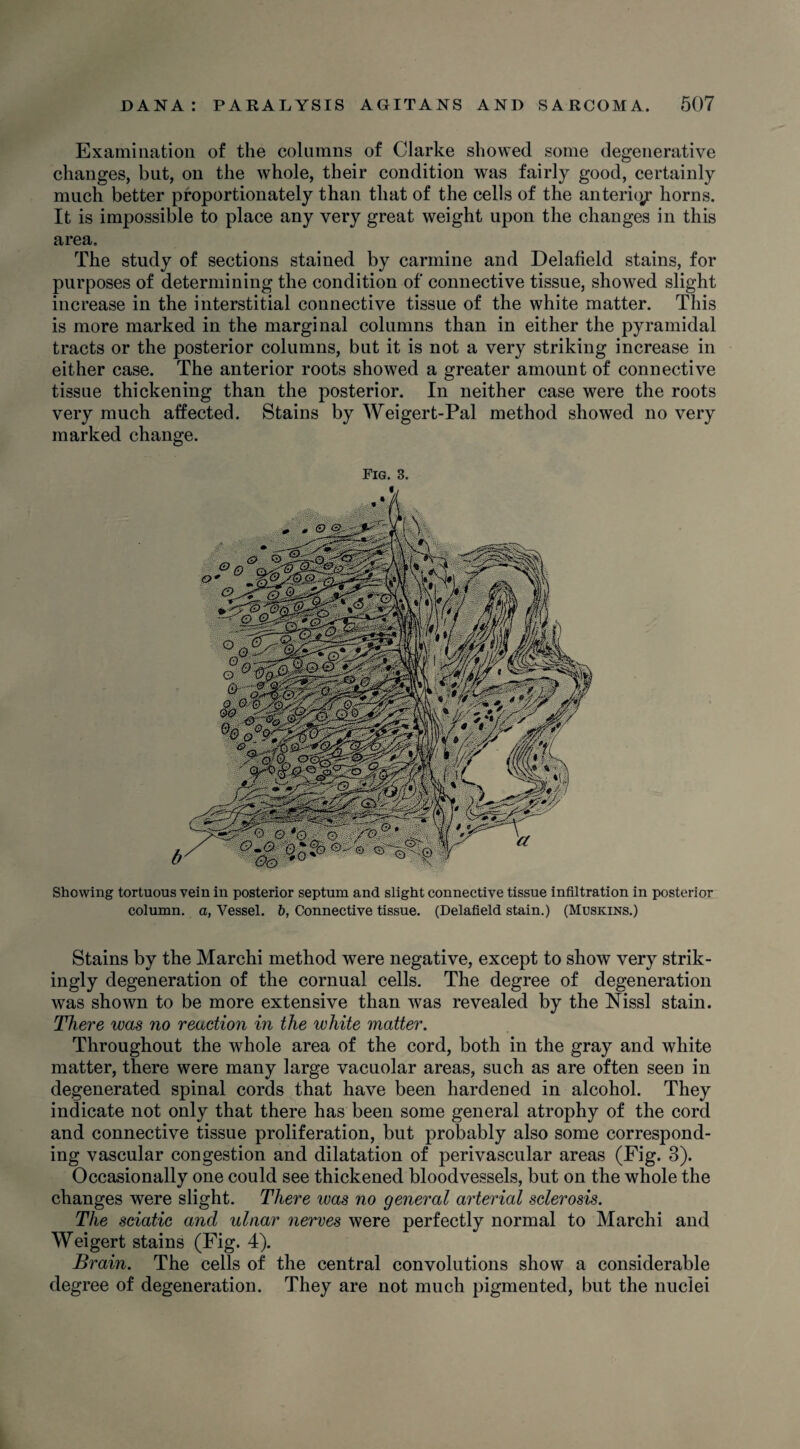 Examination of the columns of Clarke showed some degenerative changes, but, on the whole, their condition was fairly good, certainly much better proportionately than that of the cells of the anterio/ horns. It is impossible to place any very great weight upon the changes in this area. The study of sections stained by carmine and Delafield stains, for purposes of determining the condition of connective tissue, showed slight increase in the interstitial connective tissue of the white matter. This is more marked in the marginal columns than in either the pyramidal tracts or the posterior columns, but it is not a very striking increase in either case. The anterior roots showed a greater amount of connective tissue thickening than the posterior. In neither case were the roots very much affected. Stains by Weigert-Pal method showed no very marked change. Fig. 3. Showing tortuous vein in posterior septum and slight connective tissue infiltration in posterior column, a, Vessel. 6, Connective tissue. (Delafield stain.) (Muskins.) Stains by the Marchi method were negative, except to show very strik¬ ingly degeneration of the cornual cells. The degree of degeneration was shown to be more extensive than was revealed by the Nissl stain. There was no reaction in the white matter. Throughout the whole area of the cord, both in the gray and white matter, there were many large vacuolar areas, such as are often seeD in degenerated spinal cords that have been hardened in alcohol. They indicate not only that there has been some general atrophy of the cord and connective tissue proliferation, but probably also some correspond¬ ing vascular congestion and dilatation of perivascular areas (Fig. 3). Occasionally one could see thickened bloodvessels, but on the whole the changes were slight. There was no general arterial sclerosis. The sciatic and ulnar nerves were perfectly normal to Marchi and Weigert stains (Fig. 4). Brain. The cells of the central convolutions show a considerable degree of degeneration. They are not much pigmented, but the nuclei