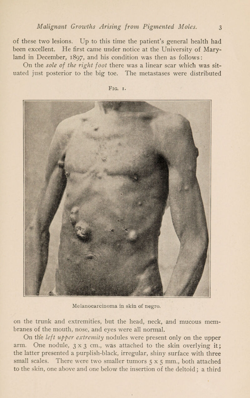 of these two lesions. Up to this time the patient’s general health had been excellent. He first came under notice at the University of Mary¬ land in December, 1897, and his condition was then as follows: On the sole of the right foot there was a linear scar which was sit¬ uated just posterior to the big toe. The metastases were distributed Fig. 1. Melanocarcinoma in skin of negro. on the trunk and extremities, but the head, neck, and mucous mem¬ branes of the mouth, nose, and eyes were all normal. On the left upper extremity nodules were present only on the upper arm. One nodule, 3x3 cm., was attached to the skin overlying it; the latter presented a purplish-black, irregular, shiny surface with three small scales. There were two smaller tumors 5x5 mm., both attached to the skin, one above and one below the insertion of the deltoid; a third