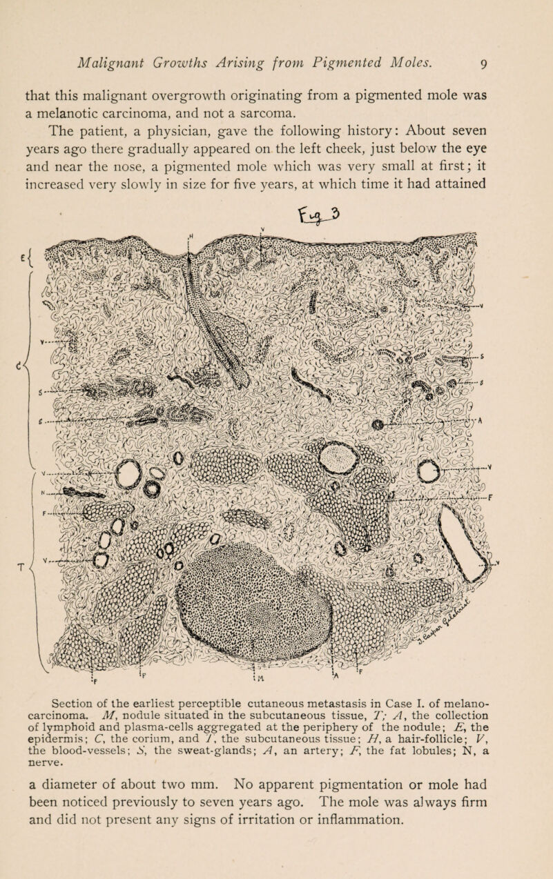 that this malignant overgrowth originating from a pigmented mole was a melanotic carcinoma, and not a sarcoma. The patient, a physician, gave the following history: About seven years ago there gradually appeared on the left cheek, just below the eye and near the nose, a pigmented mole which was very small at first; it increased very slowly in size for five years, at which time it had attained £4^ Section of the earliest perceptible cutaneous metastasis in Case I. of melano- carcinoma. M, nodule situated in the subcutaneous tissue, T; A, the collection of lymphoid and plasma-cells aggregated at the periphery of the nodule; E, the epidermis; C, the corium, and 7, the subcutaneous tissue; 77, a hair-follicle; V, the blood-vessels; S, the sweat-glands; A, an artery; F, the fat lobules; N, a nerve. a diameter of about two mm. No apparent pigmentation or mole had been noticed previously to seven years ago. The mole was always firm and did not present any signs of irritation or inflammation.