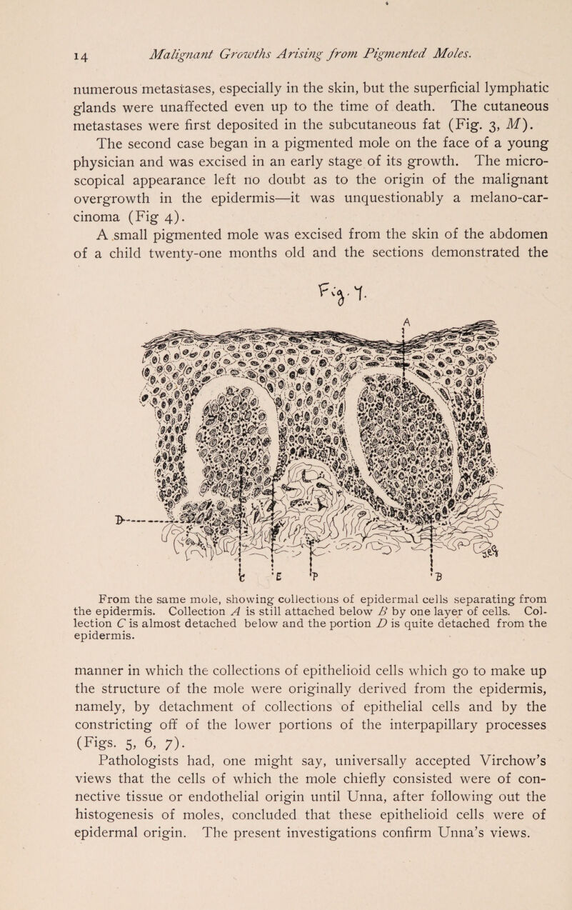 numerous metastases, especially in the skin, but the superficial lymphatic glands were unaffected even up to the time of death. The cutaneous metastases were first deposited in the subcutaneous fat (Fig. 3, M). The second case began in a pigmented mole on the face of a young physician and was excised in an early stage of its growth. The micro¬ scopical appearance left no doubt as to the origin of the malignant overgrowth in the epidermis—it was unquestionably a melano-car- cinoma (Fig 4). A small pigmented mole was excised from the skin of the abdomen of a child twenty-one months old and the sections demonstrated the From the same mole, showing collections of epidermal cells separating from the epidermis. Collection A is still attached below B by one layer of cells. Col¬ lection C is almost detached below and the portion D is quite detached from the epidermis. manner in which the collections of epithelioid cells which go to make up the structure of the mole were originally derived from the epidermis, namely, by detachment of collections of epithelial cells and by the constricting off of the lower portions of the interpapillary processes (Figs, s, 6, 7). Pathologists had, one might say, universally accepted Virchow’s views that the cells of which the mole chiefly consisted were of con¬ nective tissue or endothelial origin until Unna, after following out the histogenesis of moles, concluded that these epithelioid cells were of epidermal origin. The present investigations confirm Unna’s views.