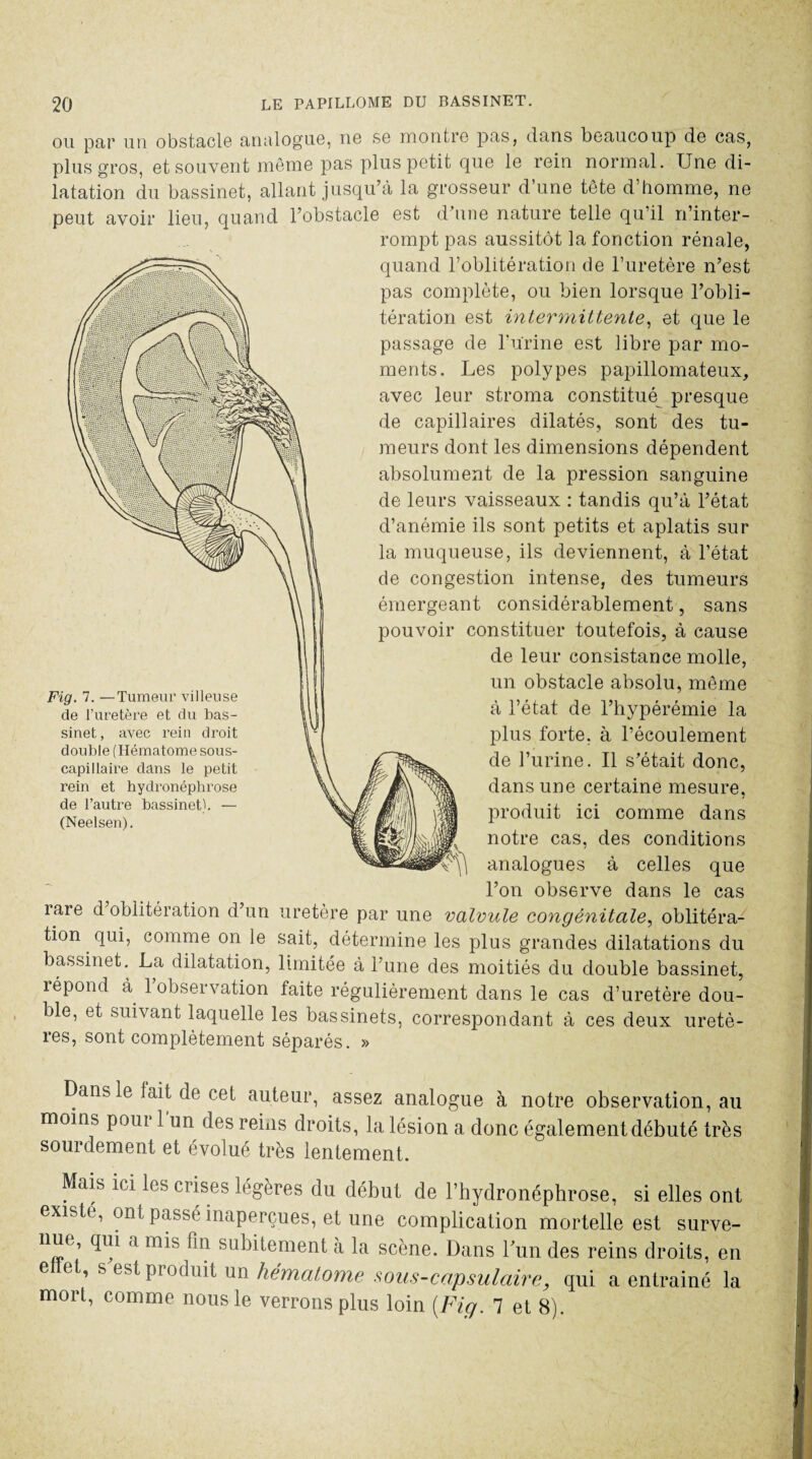 ou par un obstacle analogue, ne se montre pas, dans beaucoup de cas, plus gros, et souvent même pas plus petit pue le rein normal. Une di¬ latation du bassinet, allant jusqu’à la grosseur d’une tête d’homme, ne peut avoir lieu, quand l’obstacle est d’une nature telle qu’il n’inter¬ rompt pas aussitôt la fonction rénale, quand l’oblitération de l’uretère n’est pas complète, ou bien lorsque l’obli¬ tération est intermittente, et que le passage de burine est libre par mo¬ ments. Les polypes papillomateux, avec leur stroma constitué presque de capillaires dilatés, sont des tu¬ meurs dont les dimensions dépendent absolument de la pression sanguine de leurs vaisseaux : tandis qu’à l’état d’anémie ils sont petits et aplatis sur la muqueuse, ils deviennent, à l’état de congestion intense, des tumeurs émergeant considérablement, sans pouvoir constituer toutefois, à cause de leur consistance molle, un obstacle absolu, même à l’état de l’hypérémie la plus forte, à l’écoulement de l’urine. Il s’était donc, dans une certaine mesure, produit ici comme dans notre cas, des conditions analogues à celles que l’on observe dans le cas îare d oblitération d’un uretère par une valvule congénitale, oblitéra¬ tion qui, comme on le sait, détermine les plus grandes dilatations du bassinet. La dilatation, limitée à l’une des moitiés du double bassinet, répond à 1 observation faite régulièrement dans le cas d’uretère dou¬ ble, et suivant laquelle les bassinets, correspondant à ces deux uretè¬ res, sont complètement séparés. » Fig. 7. —Tumeur villeuse de l’uretère et du bas¬ sinet , avec rein droit double (Hématome sous- capillaire dans le petit rein et hydronéphrose de l’autre bassinet). — (Neelsen). Dans le lait de cet auteur, assez analogue à notre observation, au moins pour 1 un des reins droits, la lésion a donc également débuté très sourdement et évolué très lentement. Mais ici les crises légères du début de l’hydronéphrose, si elles ont existe, ont passé inaperçues, et une complication mortelle est surve- nuc, qui a mis fin subitement à la scène. Dans Lun des reins droits, en elïet, s est produit un hématome sous-capsulaire, qui a entraîné la mort, comme nous le verrons plus loin (Fig. 7 et 8).