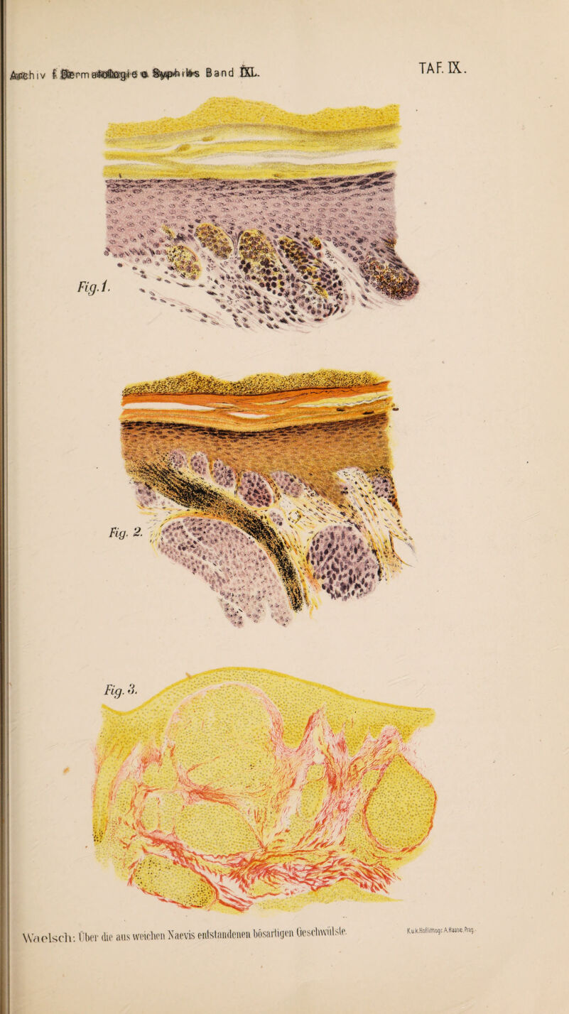 Äyrc h i v f Sfe rm eföffiaila*s Band ÖL. TAF.IX Waelsch: Ober die aus wcicUon Naevis entstandenen bösartigen üeschwiilste. K u.k.Hoflitnogr AHaase.Praq •