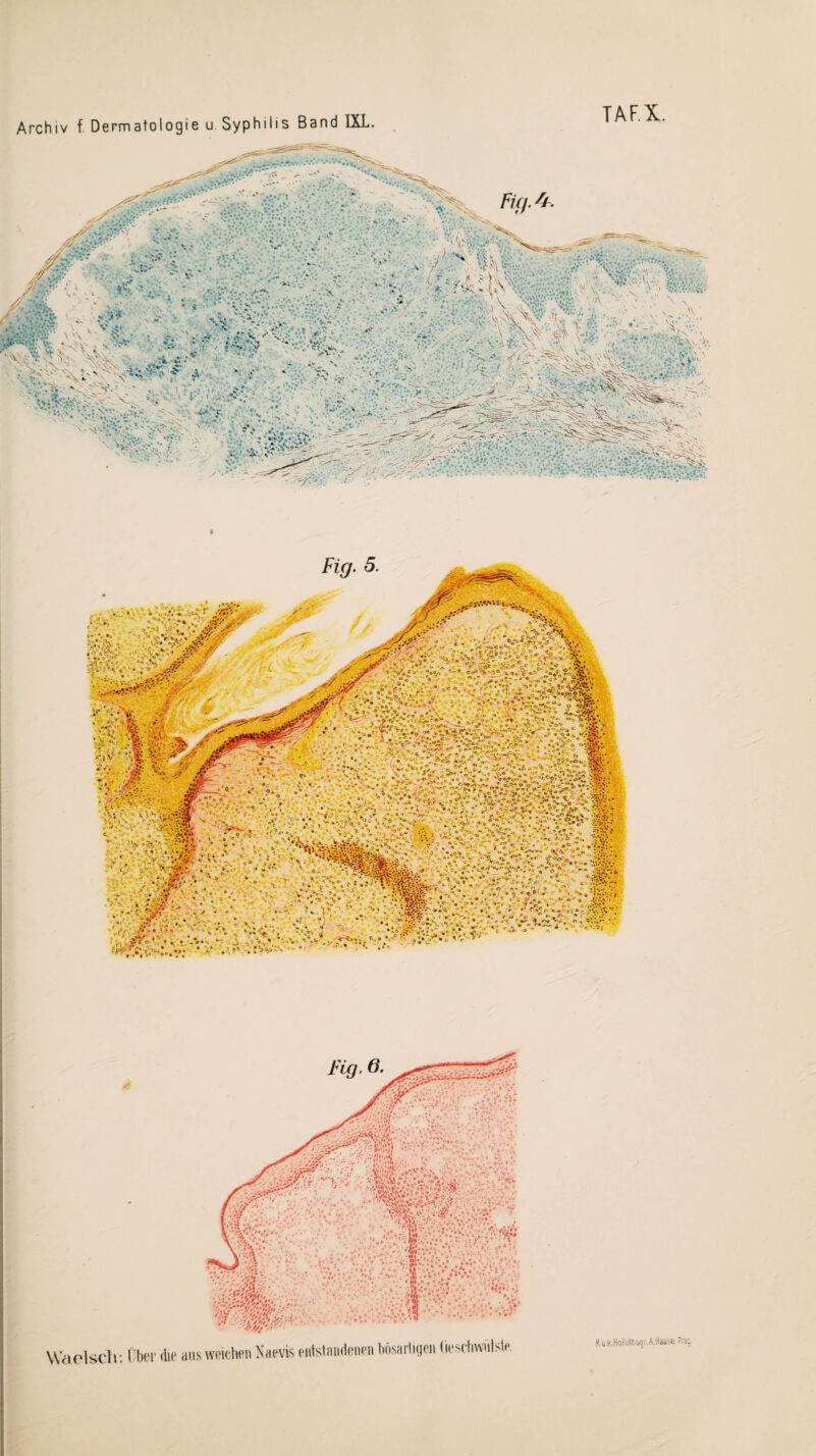 Archiv f. Dermatologie u Syphilis Band DLL. TAF.X. » Waelsch: Über die aus weichen Naevis entstandenen bösartigen üeschwiilsle. <ia CC „*’ ^ c 0, C »0*c v ' fc . '•-i . »\ * - *•»• •• K uk.HoflittloqrA.Haase.Prag