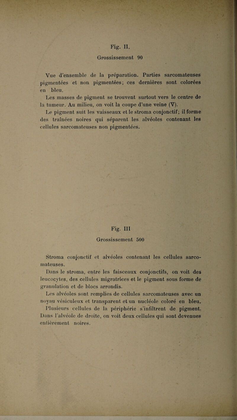 Grossissement 90 Vue d’ensemble de la préparation. Parties sarcomateuses pigmentées et non pigmentées; ces dernières sont colorées en bleu. Les masses de pigment se trouvent surtout vers le centre de la tumeur. Au milieu, on voit la coupe d’une veine (V). Le pigment suit les vaisseaux et le stroma conjonctif; il forme des traînées noires qui séparent les alvéoles contenant les cellules sarcomateuses non pigmentées. Fig. III Grossissement 500 Stroma conjonctif et alvéoles contenant les cellules sarco¬ mateuses. Dans le stroma, entre les faisceaux conjonctifs, on voit des leucocytes, des cellules migratrices et le pigment sous forme de granulation et de blocs arrondis. Les alvéoles sont remplies de cellules sarcomateuses avec un noyau vésiculeux et transparent et un nucléole coloré en bleu. Plusieurs cellules de la périphérie s’infiltrent de pigment. Dans l’alvéole de droite, on voit deux cellules qui sont devenues entièrement noires.