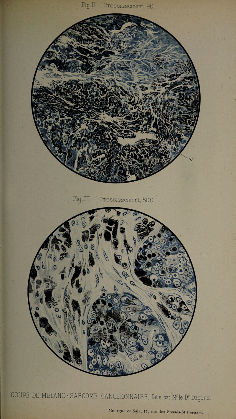 Fig. II _ Grossissement, 90 Fig. III.— Grossissement, 500 COUPE DE MÉLANO-SARCOME GANGLIONNAIRE, faite par Mrle Dr Dagonet Mourgue et Sala, li. rue des Fossés-Sl-Bernard.