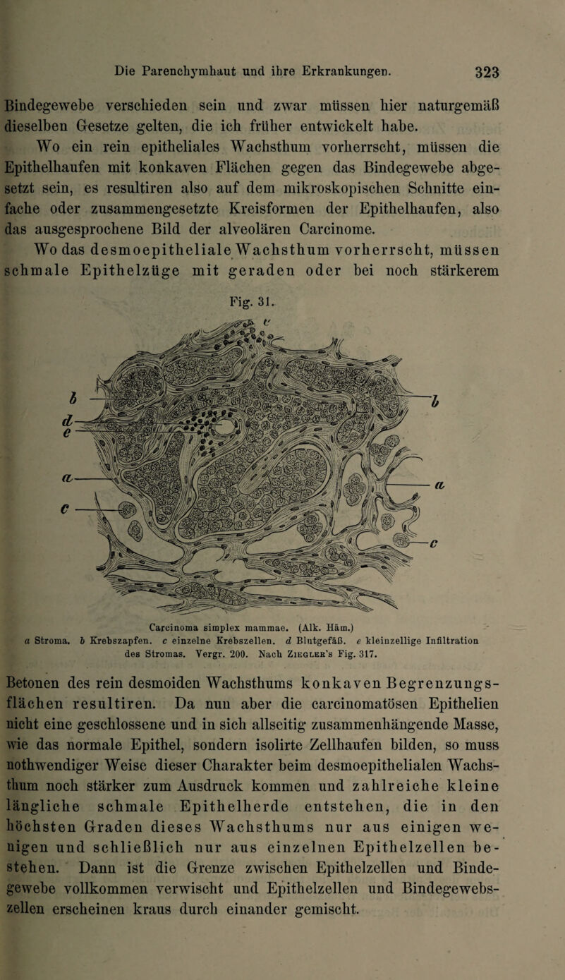 Bindegewebe verschieden sein und zwar mttssen bier naturgemaB dieselben Gesetze gelten, die ich friiher entwickelt habe. Wo ein rein epitheliales Wachsthum vorherrscht, miissen die Epithelkaufen mit konkaven Flachen gegen das Bindegewebe abge- setzt sein, es resultiren also auf dem mikroskopischen Scbnitte ein- fache oder zusammengesetzte Kreisformen der Epitlielhaufen, also das ausgesprochene Bild der alveolaren Carcinome. Wo das desmoepitheliale Wachsthum vorherrscht, miissen schmale Epitbelziige mit geraden oder bei noch starkerem Fig. 31. Carcinoma simplex mammae. (Aik. Ham.) a Stroma, b Krebszapfen. c einzelne Krebszellen. d BlutgefaB. e kleinzellige Infiltration des Stromas. Yergr. 200. Nacb Ziegler's Fig. 317. Betonen des rein desmoiden Wacksthums konkaven Begrenzungs- flachen resultiren. Da nun aber die carcinomatosen Epithelien nicbt eine geschlossene und in sich allseitig zusammenhangende Masse, wie das normale Epitbel, sondern isolirte Zellhaufen bilden, so muss nothwendiger Weise dieser Charakter beim desmoepitbelialen Wachs- tlium noch starker zum Ausdruck kommen und zahlreiche kleine langliche schmale Epithelherde entstehen, die in den hochsten Graden dieses Wachsthums nur aus einigen we- nigen und schlieBlich nur aus einzelnen Epithelzellen be- stehen. Dann ist die Grenze zwischen Epithelzellen und Binde¬ gewebe vollkommen verwischt und Epithelzellen und Bindegewebs- zellen erscheinen kraus durch einander gemischt.