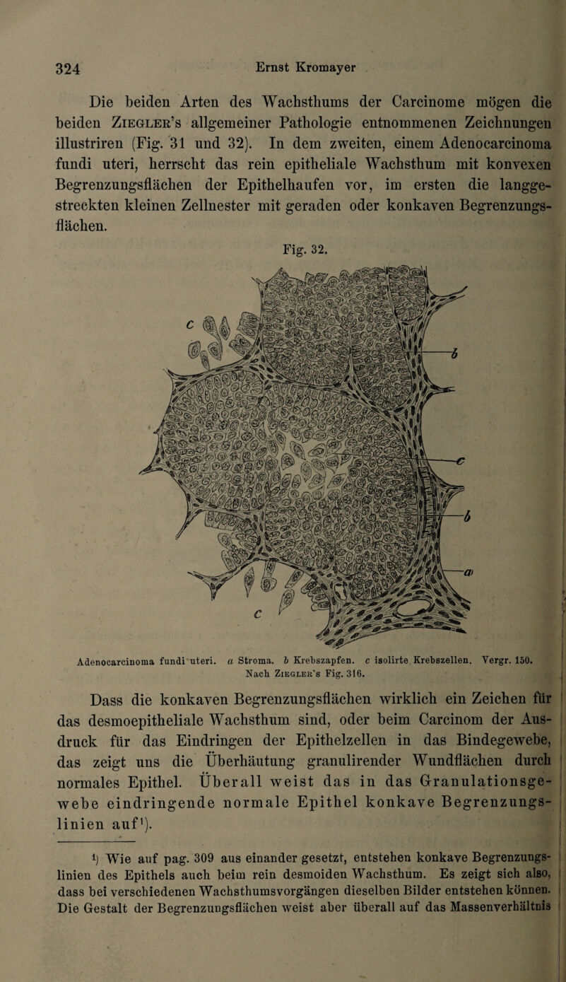 Die beiden Arten des Wachsthums der Carcinome mogen die beiden Ziegler’s allgemeiner Pathologie entnommenen Zeichnungen illustriren (Fig. 31 und 32). In dem zweiten, einem Adenocarcinoma fundi uteri, herrscht das rein epitbeliale Wachsthum mit konvexen Begrenzungsflachen der Epithelhaufen vor, im ersten die langge- streckten kleinen Zellnester mit geraden oder konkaven Begrenzungs¬ flachen. Fig. 32. Adenocarcinoma fundi uteri, a Stroma. 6 Krebszapfen. c isolirte Krebszellen. Vergr. 150. Nach Ziegler's Fig. 316. Dass die konkaven Begrenzungsflachen wirklich ein Zeichen fiir das desmoepitheliale Wachsthum sind, oder beim Carcinom der Aus- druck fiir das Eindringen der Epithelzellen in das Bindegewebe, das zeigt uns die Uberhautung granulirender Wundflachen durch normales Epithet. Uberall weist das in das Granulationsge- webe eindringende normale Epithet konkave Begrenzungs- linien auf1). i) Wie auf pag. 309 aus einander gesetzt, entstehen konkave Begrenzungs- linien des Epithels auch beim rein desmoiden Wachsthum. Es zeigt sich also, dass bei verschiedenen Wachsthumsvorgangen dieselben Bilder entstehen kbnnen. Die Gestalt der Begrenzungsflachen weist aber uberall auf das MassenverhaltDis