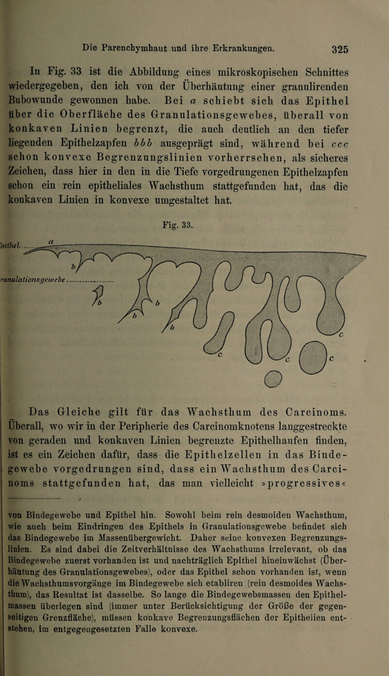 In Fig. 33 ist die Abbildung eines mikroskopischen Schnittes wiedergegeben, den ich yon der Uberhautung einer grannlirenden Bubowunde gewonnen babe. Bei a sckiebt sicb das Epithel liber die Oberflache des Granulationsgewebes, iiberall von konkaven Linien begrenzt, die aucli deutlich an den tiefer liegenden Epithelzapfen bbb ausgepragt sind, w ah rend bei ccc schon konvexe Begrenzungslinien vorherrschen, als sicheres Zeichen, dass hier in den in die Tiefe vorgedrungenen Epithelzapfen schon ein rein epitheliales Wachsthum stattgefunden hat, das die konkaven Linien in konvexe nmgestaltet hat. Fig. 33. Das Gleiche gilt fur das Wachsthum des Carcinoms. , Uberall, wo wir in der Peripherie des Carcinomknotens langgestreckte von geraden nnd konkaven Linien begrenzte Epithelhaufen finden, ist es ein Zeichen dafiir, dass die Epithelzellen in das Binde- gewebe vorgedrungen sind, dass ein Wachsthum des Carci¬ noms stattgefunden hat, das man vielleicht »progressives« von Bindegewebe und Epithel hin. Sowohl beim rein desmoiden Wachsthum, wie auch beim Eindringen des Epithets in Granulationsgewebe befindet sich das Bindegewebe im Masseniibergewicht. Daher seine konvexen Begrenzungs- linien. Es sind dabei die Zeitverhaltnisse des Wachsthums irrelevant, ob das Bindegewebe zuerst vorhanden ist und nachtriiglich Epithel hineinwachst (Uber- hiiutung des Granulationsgewebes), oder das Epithel schon vorhanden ist, wenn die Wachsthumsvorgange im Bindegewebe sich etabliren (rein desmoides Wachs¬ thum), das Resultat ist dasselbe. So lange die Bindegewebsmassen den Epithel- massen iiberlegen sind (immer unter Beriicksichtigung der GroBe der gegen- seitigen Grenzflache), miissen konkave Begrenzungsflachen der Epithelien ent- stehen, im entgegengesetzten Falle konvexe.