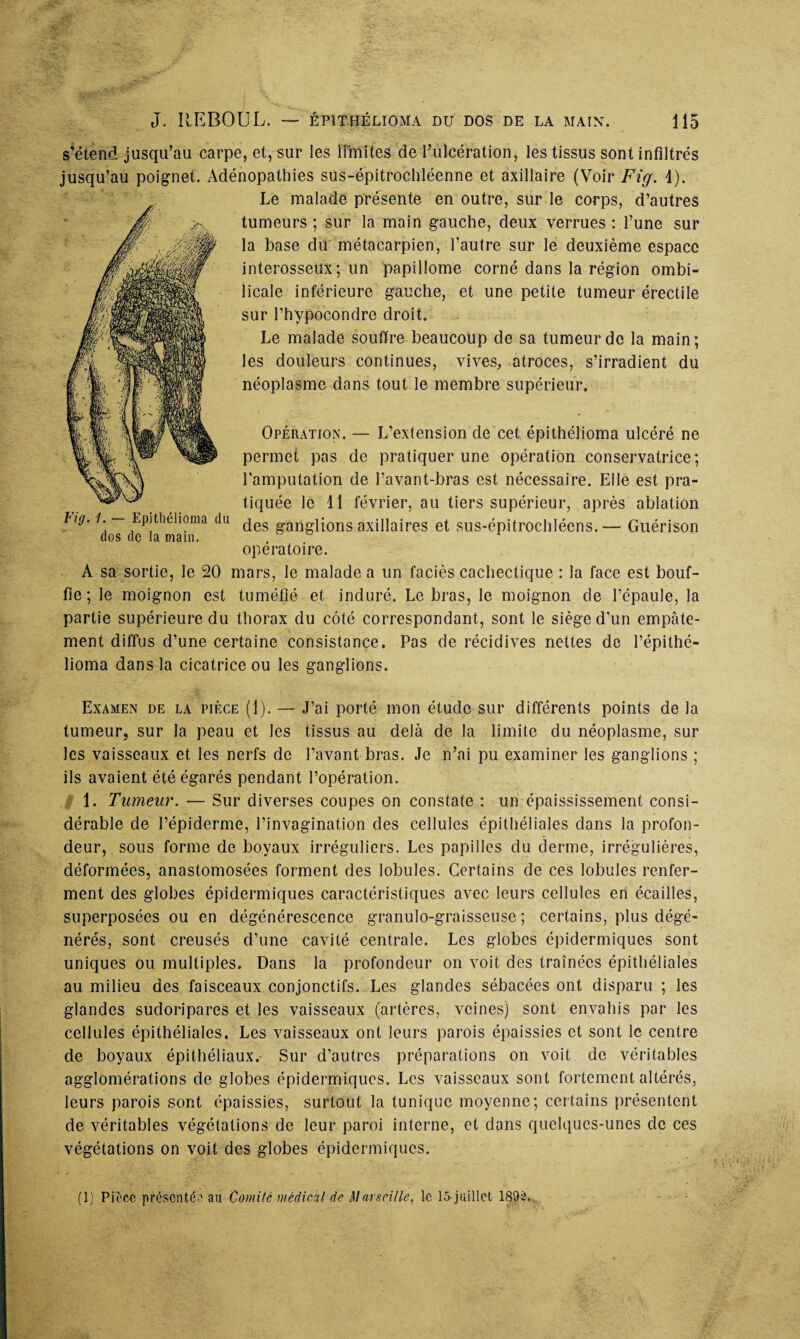 s’étend jusqu’au carpe, et, sur les limites de l’ulcération, les tissus sont infiltrés jusqu’au poignet. Adénopathies sus-épitrochléenne et axillaire (Voir Fig. 1). Le malade présente en outre, sur le corps, d’autres tumeurs ; sur la main gauche, deux verrues : l’une sur la base du métacarpien, l’autre sur le deuxième espace interosseux; un papillome corné dans la région ombi¬ licale inférieure gauche, et une petite tumeur érectile sur l’hvpocondre droit. Le malade souffre beaucoup de sa tumeur de la main; les douleurs continues, vives, atroces, s’irradient du néoplasme dans tout le membre supérieur. Opération. — L’extension de cet épithélioma ulcéré ne permet pas de pratiquer une opération conservatrice; l’amputation de l’avant-bras est nécessaire. Elle est pra¬ tiquée le 11 février, au tiers supérieur, après ablation luj. i. Epithélioma du ^es g-angiions axillaires et sus-épitrochléens.— Guérison dos de la main. . opératoire. A sa sortie, le 20 mars, le malade a un faciès cachectique : la face est bouf¬ fie; le moignon est tuméfié et induré. Le bras, le moignon de l’épaule, la partie supérieure du thorax du côté correspondant, sont le siège d’un empâte¬ ment diffus d’une certaine consistance. Pas de récidives nettes de l’épithé- lioma dans la cicatrice ou les ganglions. Examen de la pièce (1). — J’ai porté mon étude sur différents points de la tumeur, sur la peau et les tissus au delà de la limite du néoplasme, sur les vaisseaux et les nerfs de l’avant bras. Je n’ai pu examiner les ganglions ; ils avaient été égarés pendant l’opération. | 1. Tumeur. — Sur diverses coupes on constate : un épaississement consi¬ dérable de l’épiderme, l’invagination des cellules épithéliales dans la profon¬ deur, sous forme de boyaux irréguliers. Les papilles du derme, irrégulières, déformées, anastomosées forment des lobules. Certains de ces lobules renfer¬ ment des globes épidermiques caractéristiques avec leurs cellules ert écailles, superposées ou en dégénérescence granulo-graisseuse ; certains, plus dégé¬ nérés, sont creusés d’une cavité centrale. Les globes épidermiques sont uniques ou multiples. Dans la profondeur on voit des traînées épithéliales au milieu des faisceaux conjonctifs. Les glandes sébacées ont disparu ; les glandes sudoripares et les vaisseaux (artères, veines) sont envahis par les cellules épithéliales. Les vaisseaux ont leurs parois épaissies et sont le centre de boyaux épithéliaux. Sur d’autres préparations on voit de véritables agglomérations de globes épidermiques. Les vaisseaux sont fortement altérés, leurs parois sont épaissies, surtout la tunique moyenne; certains présentent de véritables végétations de leur paroi interne, et dans quelques-unes de ces végétations on voit des globes épidermiques.