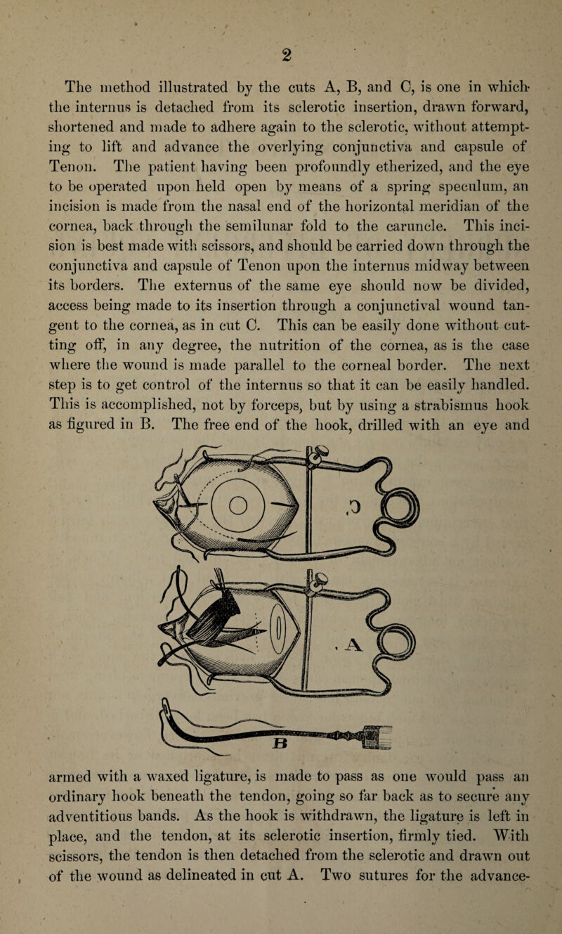 The method illustrated by the cuts A, B, and 0, is one in which- the interims is detached from its sclerotic insertion, drawn forward, shortened and made to adhere again to the sclerotic, without attempt¬ ing to lift and advance the overlying conjunctiva and capsule of Tenon. The patient having been profoundly etherized, and the eye to be operated upon held open by means of a spring speculum, an incision is made from the nasal end of the horizontal meridian of the cornea, back through the semilunar fold to the caruncle. This inci¬ sion is best made with scissors, and should be carried down through the conjunctiva and capsule of Tenon upon the interims midway between its borders. The externus of the same eye should now be divided, access being made to its insertion through a conjunctival wound tan¬ gent to the cornea, as in cut C. This can be easily done without cut¬ ting off, in any degree, the nutrition of the cornea, as is the case where the wound is made parallel to the corneal border. The next step is to get control of the internus so that it can be easily handled. This is accomplished, not by forceps, but by using a strabismus hook as figured in B. The free end of the hook, drilled with an eye and armed with a waxed ligature, is made to pass as one would pass an ordinary hook beneath the tendon, going so far back as to secure any adventitious bands. As the hook is withdrawn, the ligature is left in place, and the tendon, at its sclerotic insertion, firmly tied. With scissors, the tendon is then detached from the sclerotic and drawn out of the wound as delineated in cut A. Two sutures for the advance-