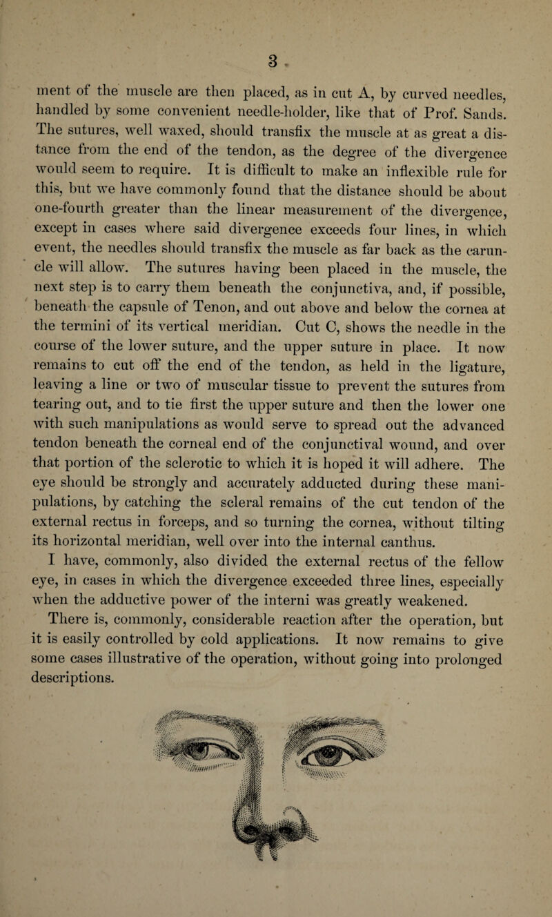 / 3 . ment of the muscle are then placed, as in cut A, by curved needles, handled by some convenient needle-holder, like that of Prof. Sands. The sutures, well waxed, should transfix the muscle at as great a dis¬ tance from the end of the tendon, as the degree of the divergence would seem to require. It is difficult to make an inflexible rule for this, but we have commonly found that the distance should be about one-fourth greater than the linear measurement of the divergence, except in cases where said divergence exceeds four lines, in which event, the needles should transfix the muscle as far back as the carun¬ cle will allow. The sutures having been placed in the muscle, the next step is to carry them beneath the conjunctiva, and, if possible, beneath the capsule of Tenon, and out above and below the cornea at the termini of its vertical meridian. Cut C, shows the needle in the course of the lower suture, and the upper suture in place. It now remains to cut off the end of the tendon, as held in the ligature, leaving a line or two of muscular tissue to prevent the sutures from tearing out, and to tie first the upper suture and then the lower one with such manipulations as would serve to spread out the advanced tendon beneath the corneal end of the conjunctival wound, and over that portion of the sclerotic to which it is hoped it will adhere. The eye should be strongly and accurately adducted during these mani¬ pulations, by catching the scleral remains of the cut tendon of the external rectus in forceps, and so turning the cornea, without tilting its horizontal meridian, well over into the internal canthus. I have, commonly, also divided the external rectus of the fellow eye, in cases in which the divergence exceeded three lines, especially when the adductive power of the interni was greatly weakened. There is, commonly, considerable reaction after the operation, but it is easily controlled by cold applications. It now remains to give some cases illustrative of the operation, without going into prolonged descriptions.