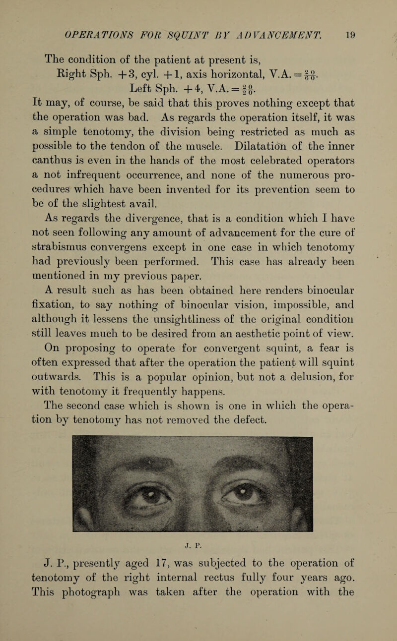 The condition of the patient at present is, Right Sph. +3, cyl. +1, axis horizontal, V.A. = |-§-. Left Sph. +4, V.A. = f£. It may, of course, be said that this proves nothing except that the operation was bad. As regards the operation itself, it was a simple tenotomy, the division being restricted as much as possible to the tendon of the muscle. Dilatation of the inner canthus is even in the hands of the most celebrated operators a not infrequent occurrence, and none of the numerous pro¬ cedures which have been invented for its prevention seem to be of the slightest avail. As regards the divergence, that is a condition which I have not seen following any amount of advancement for the cure of strabismus convergens except in one case in which tenotomy had previously been performed. This case has already been mentioned in my previous paper. A result such as has been obtained here renders binocular fixation, to say nothing of binocular vision, impossible, and although it lessens the unsightliness of the original condition still leaves much to be desired from an aesthetic point of view. On proposing to operate for convergent squint, a fear is often expressed that after the operation the patient will squint outwards. This is a popular opinion, but not a delusion, for with tenotomy it frequently happens. The second case which is shown is one in which the opera¬ tion by tenotomy has not removed the defect. j. p. J. P., presently aged 17, was subjected to the operation of tenotomy of the right internal rectus fully four years ago. This photograph was taken after the operation with the