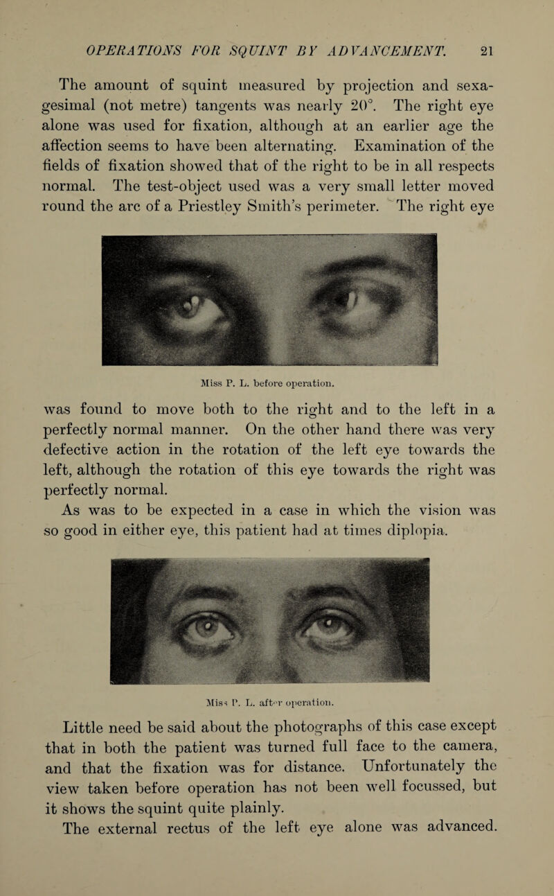 The amount of squint measured by projection and sexa¬ gesimal (not metre) tangents was nearly 20°. The right eye alone was used for fixation, although at an earlier age the affection seems to have been alternating. Examination of the fields of fixation showed that of the right to be in all respects normal. The test-object used was a very small letter moved round the arc of a Priestley Smith’s perimeter. The right eye Miss P. L. before operation. was found to move both to the right and to the left in a c5 perfectly normal manner. On the other hand there was very defective action in the rotation of the left eye towards the left, although the rotation of this eye towards the right was perfectly normal. As was to be expected in a case in which the vision was so good in either eye, this patient had at times diplopia. Miss P. L. aft'T operation. Little need be said about the photographs of this case except that in both the patient was turned full face to the camera, and that the fixation was for distance. Unfortunately the view taken before operation has not been well focussed, but it shows the squint quite plainly. The external rectus of the left eye alone was advanced.