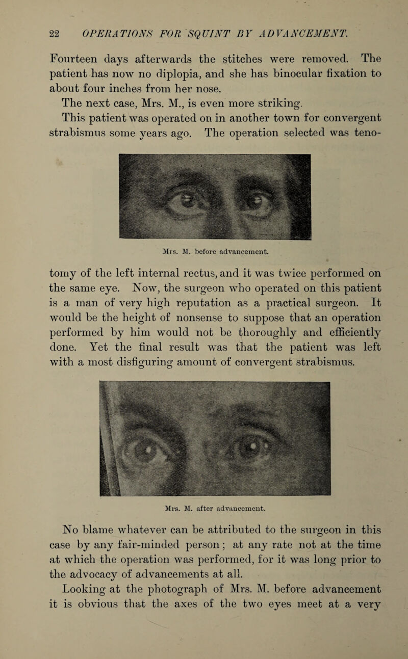 Fourteen days afterwards the stitches were removed. The patient has now no diplopia, and she has binocular fixation to about four inches from her nose. The next case, Mrs. M., is even more striking. This patient was operated on in another town for convergent strabismus some years ago. The operation selected was teno- Mrs. M. before advancement. tomy of the left internal rectus, and it was twice performed on the same eye. Now, the surgeon who operated on this patient is a man of very high reputation as a practical surgeon. It would be the height of nonsense to suppose that an operation performed by him would not be thoroughly and efficiently done. Yet the final result was that the patient was left with a most disfiguring amount of convergent strabismus. Mrs. M. after advancement. No blame whatever can be attributed to the surgeon in this case by any fair-minded person; at any rate not at the time at which the operation was performed, for it was long prior to the advocacy of advancements at all. Looking at the photograph of Mrs. M. before advancement it is obvious that the axes of the two eyes meet at a very