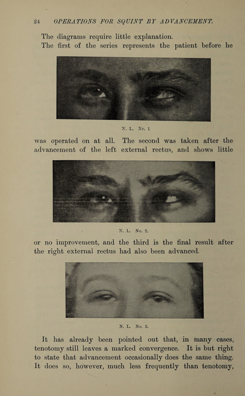 The diagrams require little explanation. The first of the series represents the patient before he N. L. No. 1 was operated on at all. The second was taken after the advancement of the left external rectus, and shows little N. L. No. 2. or no improvement, and the third is the final result after the right external rectus had also been advanced. N. L. No. 3. It has already been pointed out that, in many cases, tenotomy still leaves a marked convergence. It is but right to state that advancement occasionally does the same thing. It does so, however, much less frequently than tenotomy,