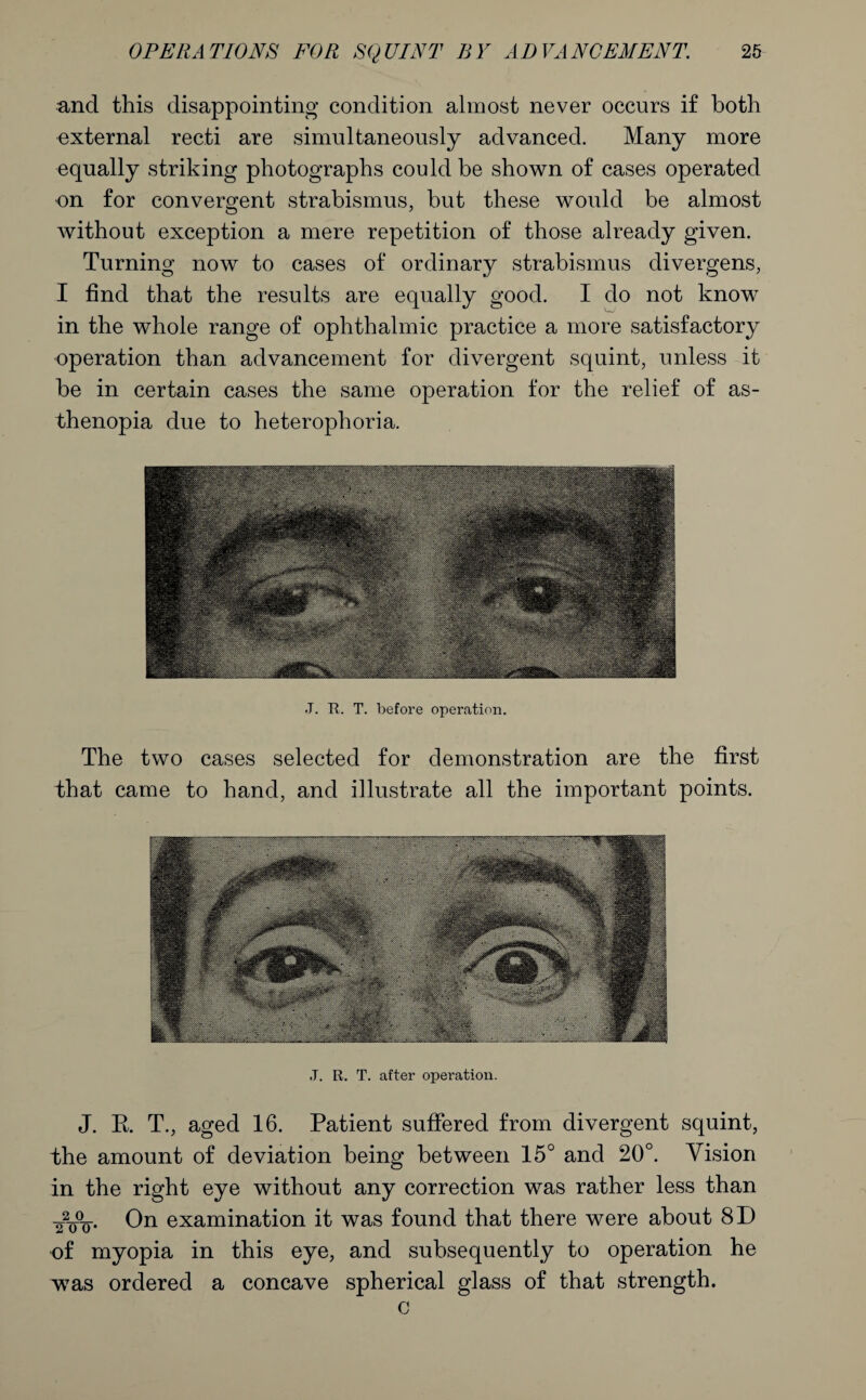 and this disappointing condition almost never occurs if both external recti are simultaneously advanced. Many more equally striking photographs could be shown of cases operated on for convergent strabismus, but these would be almost without exception a mere repetition of those already given. Turning now to cases of ordinary strabismus divergens, I find that the results are equally good. I do not know in the whole range of ophthalmic practice a more satisfactory operation than advancement for divergent squint, unless it be in certain cases the same operation for the relief of as¬ thenopia due to heterophoria. J. R. T. before operation. The two cases selected for demonstration are the first that came to hand, and illustrate all the important points. ,T. R. T. after operation. J. R. T., aged 16. Patient suffered from divergent squint, the amount of deviation being between 15° and 20°. Vision in the right eye without any correction was rather less than 2%. On examination it was found that there were about 8D -of myopia in this eye, and subsequently to operation he w7as ordered a concave spherical glass of that strength. c