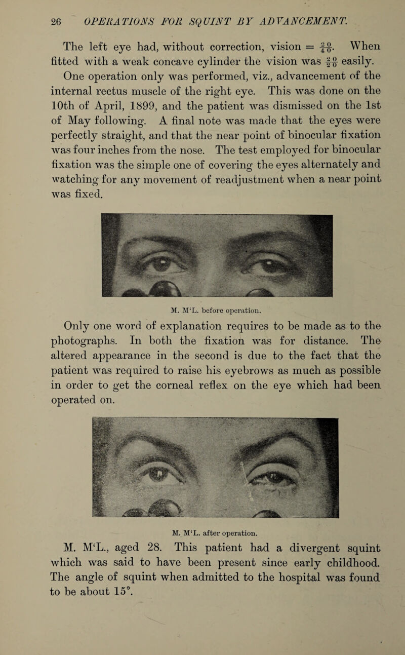 The left eye had, without correction, vision = When fitted with a weak concave cylinder the vision was f-g- easily. One operation only was performed, viz., advancement of the internal rectus muscle of the right eye. This was done on the 10th of April, 1899, and the patient was dismissed on the 1st of May following. A final note was made that the eyes were perfectly straight, and that the near point of binocular fixation was four inches from the nose. The test employed for binocular fixation was the simple one of covering the eyes alternately and watching for any movement of readjustment when a near point was fixed. M. M‘L. before operation. Only one word of explanation requires to be made as to the photographs. In both the fixation was for distance. The altered appearance in the second is due to the fact that the patient was required to raise his eyebrows as much as possible in order to get the corneal reflex on the eye which had been operated on. M. M‘L. after operation. M. M‘L., aged 28. This patient had a divergent squint which was said to have been present since early childhood. The angle of squint when admitted to the hospital was found to be about 15°.