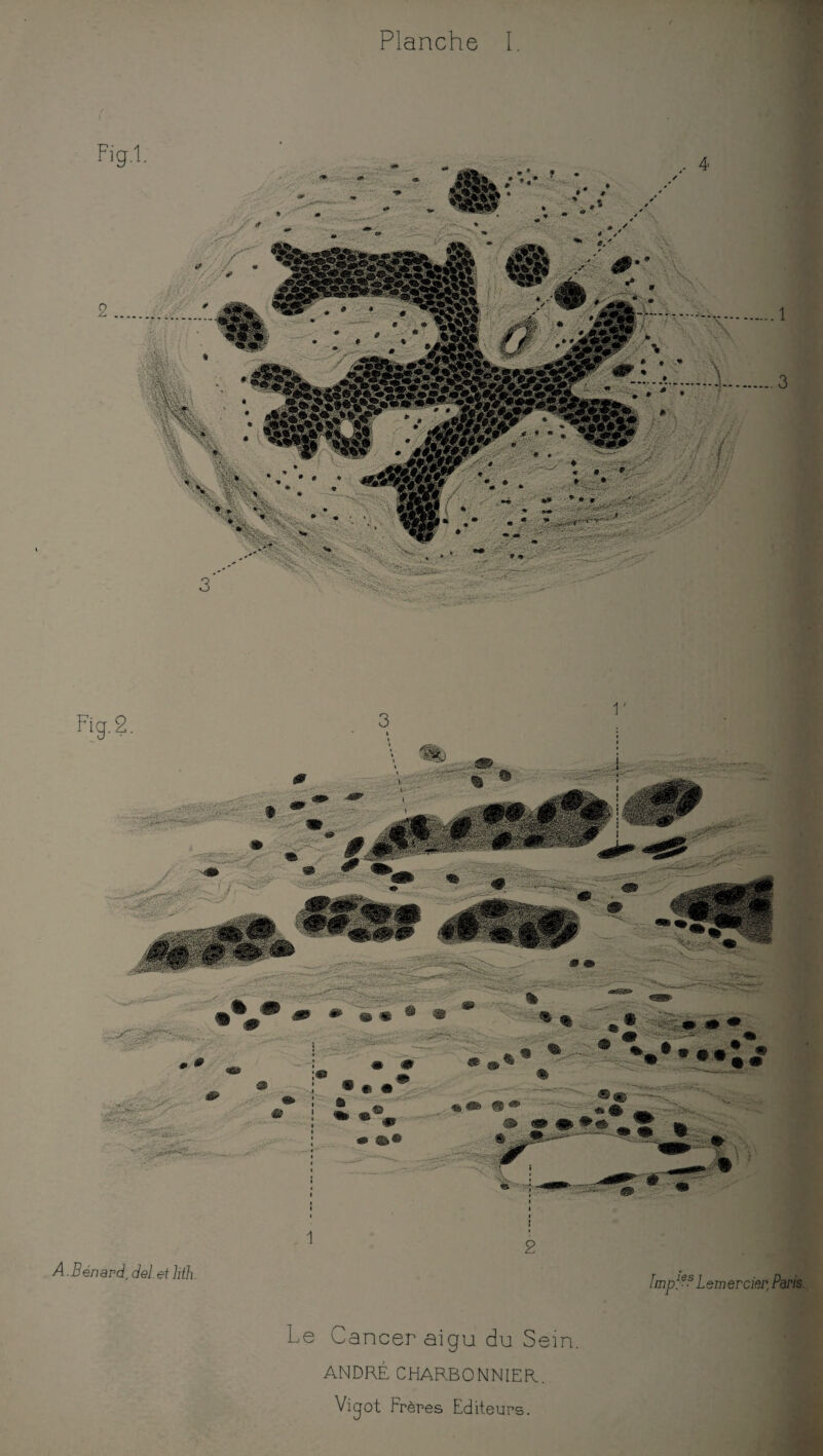 A.Bénard, del.et Jith. lmples Lemercier, Paris. Le Cancer aigu du Sein. ANDRÉ CHARBONNIER..