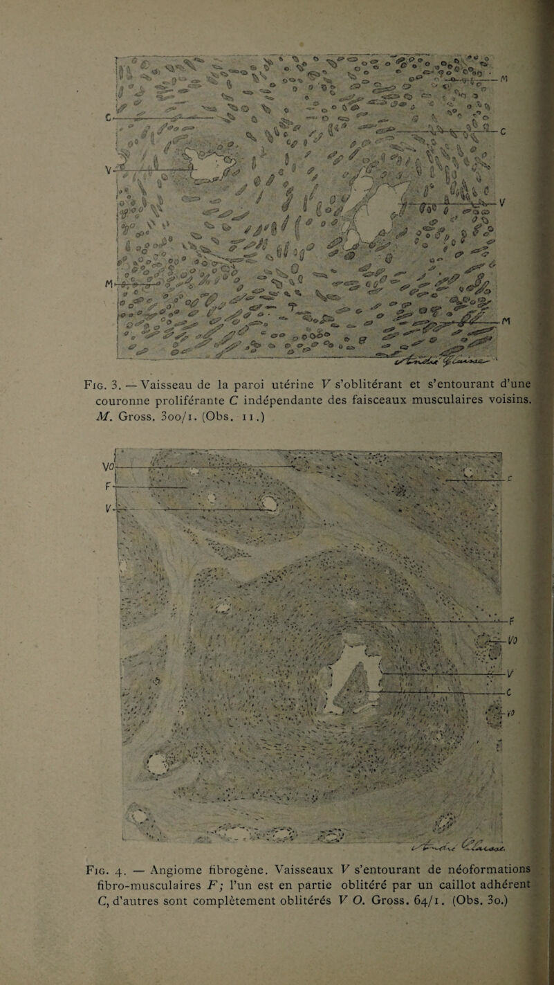 T '.. ' Nà * ^ irV A W ^ ^ O <S - ,, '^T »»• il”J, TW'* , • 0 >© \ ^ ft i 0 - <s> v n >ij fj^xa -“va __ o ^ ^ '•* ——'j'i 'J * r C - •*■ -Sf* ^ Cà o «a> ^ — '5 ^ * £ ° 1 »• ‘ ,»•■'/.- a». V4 V • ^ » > -Ji—.-à- ../ , !' . 5 a rtï , -b »V ,’ *<F* i• /V ' Vb&% \î \U,\ !Tr;i* &?*£?'£* iùÆf i r \ A C '&. Q v ' 1 ' ,ü v *■&.•*• *r>-r &w;î *■-,■« .* **2, />«-. * .vî?-^ V Vr *<.£ ■* <v>& O O ° <? I’... a- «v Tse! “' & £> ïSz» ° ;*r*> <~ * ^ oocpc 00 a??e»a & i\., ^ i ^ ^ af £o.o0C i ^ ° ^ ^ O O' /*<*%. c* tf» ^ ■-*• ^&..?s*-«r^-—- okgo ^ J? **s^ O tu> _jp ^ * . ^ l/ • ^>a ° p - ^ ^ ’”%i5i»' <£. C***^ZÆ. Fig. 3.—Vaisseau de la paroi utérine F s’oblitérant et s’entourant d’une couronne proliférante C indépendante des faisceaux musculaires voisins. A/. Gross. 3oo/i. (Obs. n.) Fig. 4. — Angiome fibrogène. Vaisseaux V s’entourant de néoformations fibro-musculaires F ; l’un est en partie oblitéré par un caillot adhérent