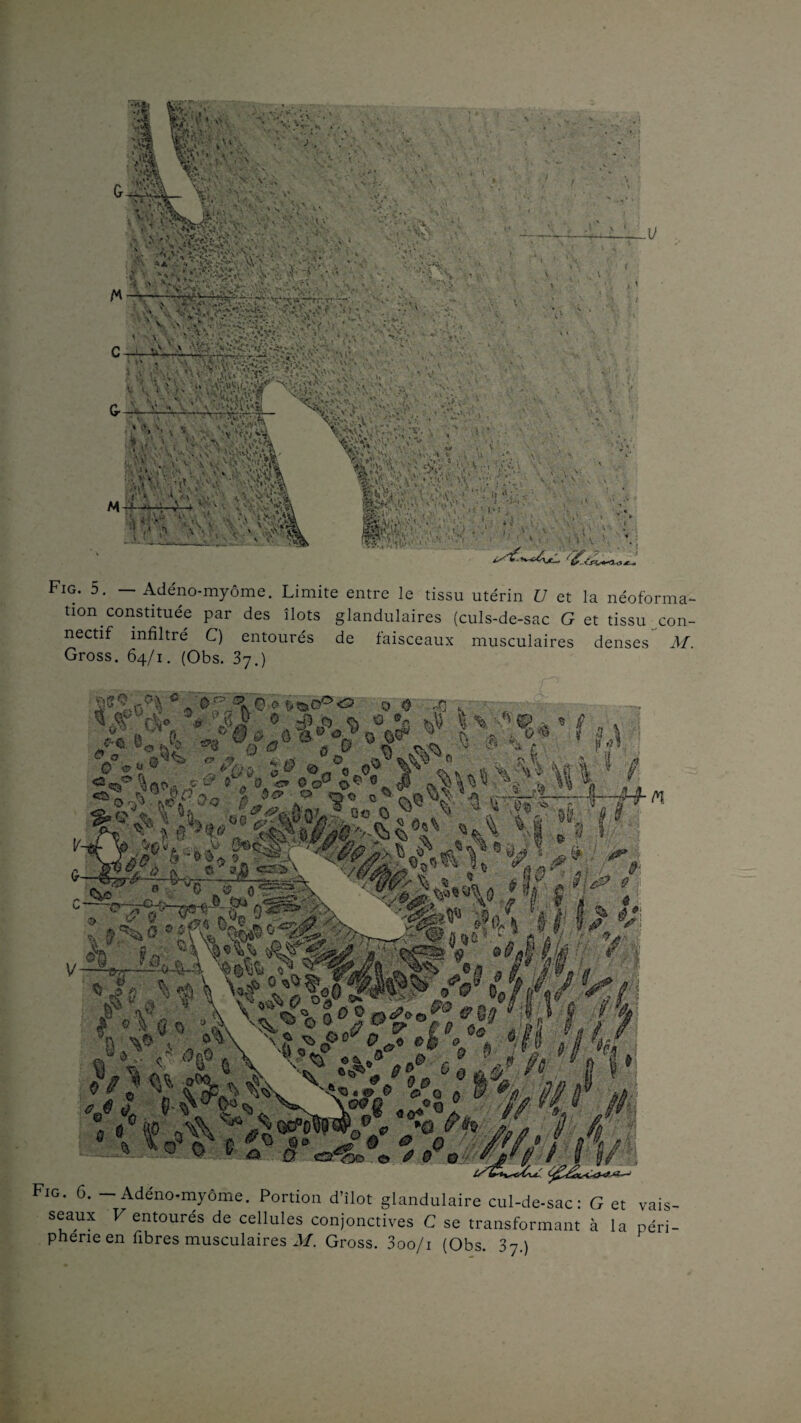 # > . -o v. V- V 4 . V. * ' î > î ‘ N •• ' \ v^v _ v^.;;. .-•• *•-: * ‘ v_ ,' -v ■»*» • — ‘ * ^ ■• \ * v v-A-* « :;ÿ*Vv*u'.\>'v*v)./ » . .-■*• • v *. ' - - c -i.. u\’ t_1 v » ... V'vvWîîs; • !••'*'J, . », ’ \ < vr\vs . ' v. . '•■ \ • •• <- V.'iV r'.ù’P ■■'■ ,.~V CL. >' •> ' • \ \ ; • ' '*» '• v * '-vV-jttj ■■“.•. v :v- . tf ;>v v\ \>a*» i [ •*/' , • ■\‘yi> su. i»i •f\ Vl\ ' - ;C j '.\'S ■ t S : •: ÎVkVi-,v. < ,s. #£$iV) • ■ mw1 . •' * V; k \ IM m -V' %*r,l' Fig. 5. — Adéno-myôme. Limite entre le tissu utérin t/ et la néoforma¬ tion constituée par des îlots glandulaires (culs-de-sac G et tissu con¬ nectif infiltré C) entourés de faisceaux musculaires denses M. Gross. 64/1. (Obs. 37.) ÿ*U°v\ « ôM ào »»oPo 0 0 vn . ■ \ , ^ fV °# jSjf 0 -P O <v O ®r. b /.« •• «* W V* 0 § Wy 'fi - 4 . ï? ' Y *ùi ^ - S\ 111 : n M *.; il—o 0%?®^ o.V;? mAO.i x“ 5 „ 0. 6 ° O ^ a. ^ QC 0 ^ ^ 'l .3* f\H fi ^ hS m rs f ’ ^a-o c r^r - (y « ' gA> <=va.\ V&Æ0 v ?v I Sv? / CM, » “0 „®. * h î J C-^'^V y.8»-f 9«S' ?>» N^Sfey Y. f i, I i 5k i.: 0V v o c ■ ^ « ’ ‘ > ' •- ô t >/s „ —■—y O’# J « « f»’ -6 5Xo 4'/ / tS&JUCL Fig. C. - Adéno-myôme. Portion d’îlot glandulaire cul-de-sac: G et vais¬ seaux F entourés de cellules conjonctives C se transformant à la péri-