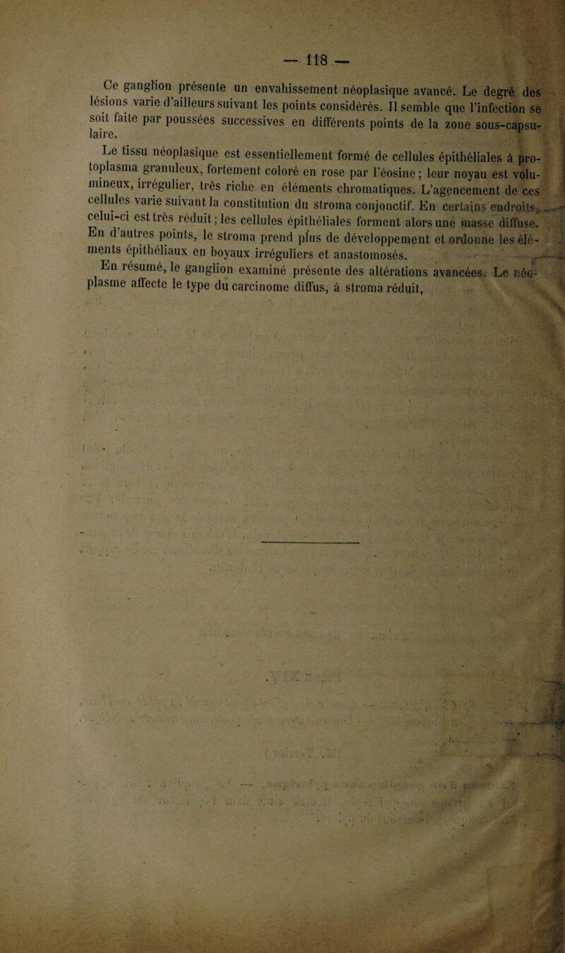 Ce ganglion présente un envahissement néoplasique avancé. Le degré des lésions varie d’ailleurs suivant les points considérés. Il semble que l’infection se soi! faite par poussées successives en différents points de la zone sous-capsu¬ laire. Le tissu néoplasique est essentiellement formé de cellules épithéliales à pro¬ toplasma gianuleux, fortement coloré en rose par l’éosine; leur noyau est volu¬ mineux, irrégulier, très riche en éléments chromatiques. L’agencement de ces cellules varie suivant la constitution du stroma conjonctif. En certains endroits, celui-ci est très réduit; les cellules épithéliales forment alors une masse diffuse. En d autres points, le stroma prend plus de développement et ordonne les élé¬ ments épithéliaux en hoyaux irréguliers et anastomosés. En îésumé, le ganglion examiné présente des altérations avancées. Le néo¬ plasme affecte le type du carcinome diffus, à stroma réduit, r