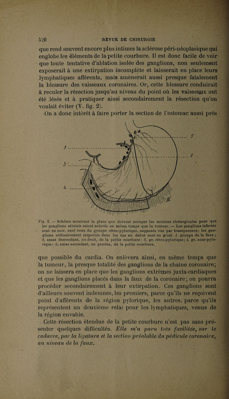 que rend souvent encore plus intimes la sclérose péri-néoplasique qui englobe les éléments de la petite courbure. Il est donc facile de voir que toute tentative d’ablation isolée des ganglions, non seulement exposerait à une extirpation incomplète et laisserait en place leurs lymphatiques afférents, mais amènerait aussi presque fatalement la blessure des vaisseaux coronaires. Or, cette blessure conduirait à reculer la résection jusqu’au niveau du point où les vaisseaux ont été lésés et à pratiquer ainsi secondairement la résection qu’on voulait éviter (Y. fig. 2). On a donc intérêt à faire porter la section de l’estomac aussi près Fig. 2. — Schéma montrant, la place que doivent occuper les sections chirurgicales pour que les ganglions atteints soient enlevés en même temps que la tumeur. — Les ganglions infectés sont en noir, sauf ceux du groupe rétro-pylorique, supposés vus par transparence; les gan¬ glions ordinairement respectes dans les Cas au début sont en grisé. /. groupe de la faux ; 2, amas descendant, ou droit, de la petite courbure; 3, gr. rétro-pylorique ; 4, gr. sous-pylo- rique; 5, amas ascendant, ou gauche, de la petite courbure. que possible du cardia. On enlèvera ainsi, en même temps que la tumeur, la presque totalité des ganglions de la chaîne coronaire; on ne laissera en place que les ganglions extrêmes juxta-cardiaques et que les ganglions placés dans la faux de la coronaire; on pourra procéder secondairement à leur extirpation. Ces ganglions sont d’ailleurs souvent indemnes, les premiers, parce qu’ils ne reçoivent point d’afférents de la région pylorique, les autres, parce qu’ils représentent un deuxième relai pour les lymphatiques, venus de la région envahie. Cette résection étendue de la petite courbure n’est pas sans pré¬ senter quelques difficultés. Elle m’a paru très facilitée, sur le cadavre, par la ligature et la section préalable du pédicule coronaire, au niveau de la faux.