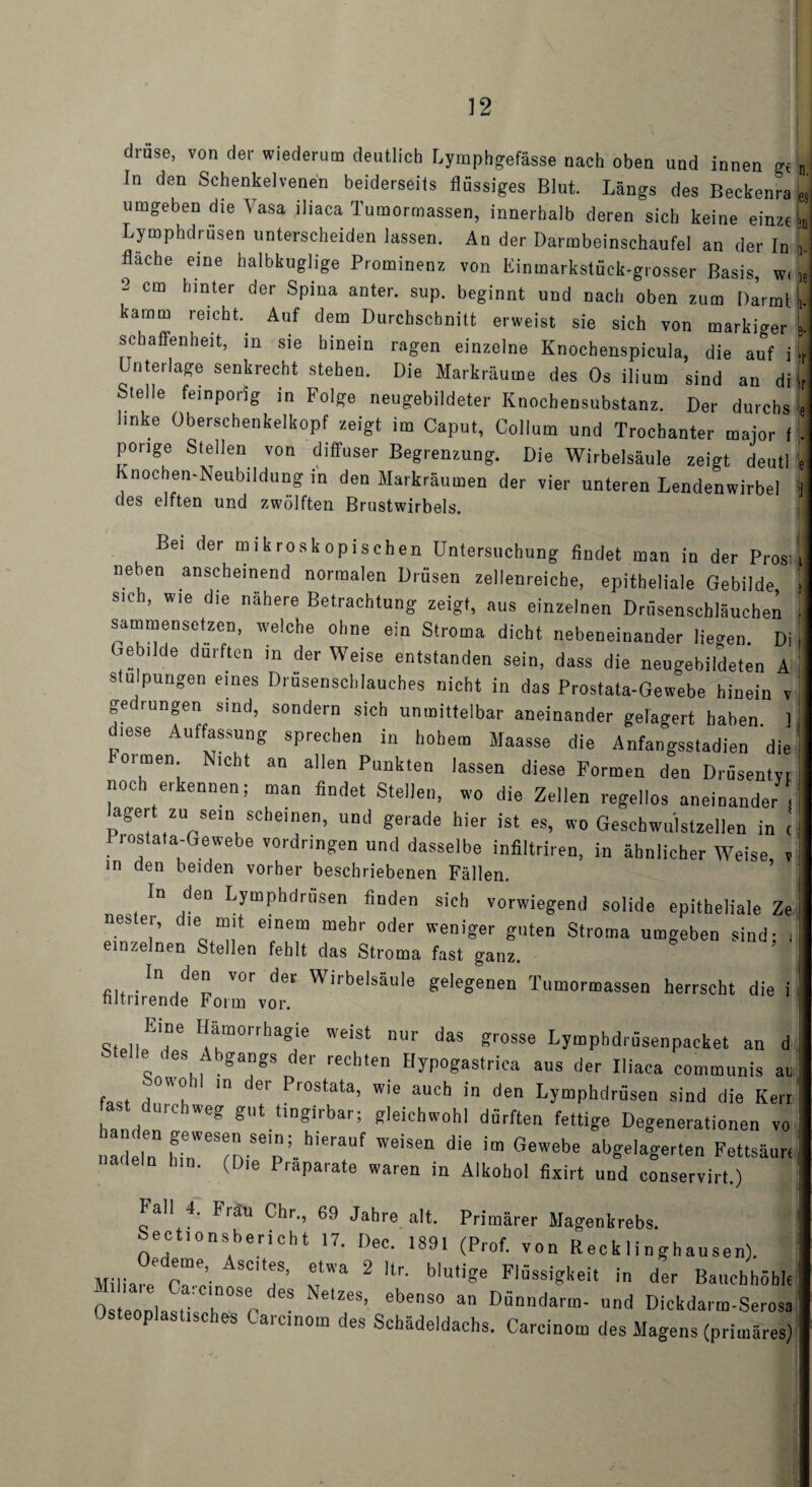 drüse, von der wiederum deutlich Lymphgefässe nach oben und innen g< In den Schenkelvenen beiderseits flüssiges Blut. Längs des Beckenra umgeben die Vasa iliaca Tumormassen, innerhalb deren sich keine einze fläche eine halbkuglige Prominenz von Einmarkstück-grosser Basis, w< 2 cm hinter der Spina anter. sup. beginnt und nach oben zum Darmt kämm reicht. Auf dem Durchschnitt erweist sie sich von markiger scbaffenheit, in sie hinein ragen einzelne Knochenspicula, die auf i Unterlage senkrecht stehen. Die Markräume des Os ilium sind an di Stelle feinporig in Folge neugebildeter Knochensubstanz. Der durchs linke Oberschenkelkopf zeigt im Caput, Collum und Trochanter major f porige Stellen von diffuser Begrenzung. Die Wirbelsäule zeigt deutl vnochen-Neubildung in den Markräumen der vier unteren Lendenwirbel des elften und zwölften Brustwirbels. Bei der mikroskopischen Untersuchung findet man in der Prosi neben anscheinend normalen Drüsen zeilenreiche, epitheliale Gebilde sich, wie die nähere Betrachtung zeigt, aus einzelnen Drüsenschläuchen sammensetzen, welche ohne ein Stroma dicht nebeneinander liegen. Di .ebilde durften m der Weise entstanden sein, dass die neugebildeten A stulpungen eines Drusenschlauches nicht in das Prostata-Gewebe hinein v gedrungen sind, sondern sich unmittelbar aneinander gelagert haben ] diese Auffassung sprechen in hohem Maasse die Anfangsstadien die hoi men. Nicht an allen Punkten lassen diese Formen den Drüsentvr noch erkennen; man findet Stellen, wo die Zellen regellos aneinander agert zu sein scheinen, und gerade hier ist es, wo Geschwulstzellen in r Prostata-Gewebe Vordringen und dasselbe infiltriren, in ähnlicher Weise, v in den beiden vorher beschriebenen Fällen. In den Lymphdrüsen finden sich vorwiegend solide epitheliale Ze nester, die mit einem mehr oder weniger guten Stroma umgeben sind; , einzelnen Stellen fehlt das Stroma fast ganz. In den vor der Wirbelsäule gelegenen Tumormassen herrscht die i nltnrende Form vor. Eine Hämorrbagie weist nur das grosse Lympbdräsenpacket an d Sleile des Abgangs der rechten Hypogastrica aus der Iliaca communis ac fast 10 er Prostata’ wie aucb in den Lymphdrüsen sind die Kerr ast durchweg gut üngirbar; gleichwohl dürften fettige Degenerationen vo nadeln hinWeSfDSep;- aUf WeiSen die im Gewebe “^lagerten Fettsäur, nadeln hin. (Die Präparate waren in Alkohol fixirt und conservirt.) Fall 4. Frau Ohr., 69 Jahre alt. Primärer Magenkrebs. Sectio ns bericht 17. Dec. 1891 (Prof, von Recklinghausen). MiliaiJ <w SC.S’ v* 2 ltr' b'U,ige Flüssigkeit in der Bauchhöhle Osteonlas, rSp ' ebenS° a Dönnda™- »nd Dickdarm-Serosa Osteoplastisches Carc.nom des Schädeldachs. Carcinom des Magens (primäres) < n.