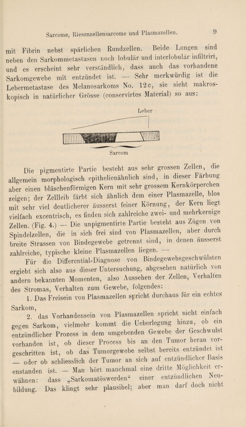 mit Fibrin nebst spärlichen Rundzellen. Beide Lungen sind neben den Sarkommetastasen noch lobulär und interlobulär infiltrirt, und es erscheint sehr verständlich, dass auch das vorhandene Sarkomgewebe mit entzündet ist. — Sehr merkwürdig ist die Lebermetastase des Melanosarkoms No. 12c, sie sieht makros¬ kopisch in natürlicher Grösse (conservirtes Material) so aus: Leber Sarcom Die pigmentirte Partie besteht aus sehr grossen Zellen, die allgemein morphologisch epithelienähnlich sind, in dieser Färbung aber einen bläschenförmigen Kern mit sehr grossem Kernkörperchen zeigen; der Zellleib färbt sich ähnlich dem einer Plasmazelle, blos mit sehr viel deutlicherer äusserst feiner Körnung, der Kern hegt vielfach excentrisch, es finden sich zahlreiche zwei- und mehrkernige Zellen. (Fig. 4-) — Die unpigmentirte Partie besteht aus Zügen von Spindel zellen, die in sich frei sind von Plasmazellen, aber durch breite Strassen von Bindegewebe getrennt sind, in denen äusserst zahlreiche, typische kleine Plasmazellen liegen. Für die Differential-Diagnose von Bindegewebsgeschwulsten ergebt sich also aus dieser Untersuchung, abgesehen natürlich von andern bekannten Momenten, also Aussehen der Zellen, Verhalten des Stromas, Verhalten zum Gewebe, folgendes: 1. Das Freisein von Plasmazellen spricht durchaus für ein echtes Sarkom, . r , 2. das Vorhandensein von Plasmazellen spricht nicht emlacii gegen Sarkom, vielmehr kommt die Ueberlegung hinzu, ob ein entzündlicher Prozess in dem umgebenden Gewebe der Geschwulst vorhanden ist, ob dieser Process bis an den Tumor heran vor¬ geschritten ist, ob das Tumorgewebe selbst bereits entzündet ist — oder ob schliesslich der Tumor an sieh auf entzündlicher Basis enstanden ist. - Man hört manchmal eine dritte Möglichkeit er¬ wähnen: dass „Sarkomatöswerden“ einer entzündlichen Neu¬ bildung. Das klingt sehr plausibel; aber man darf doch nicht