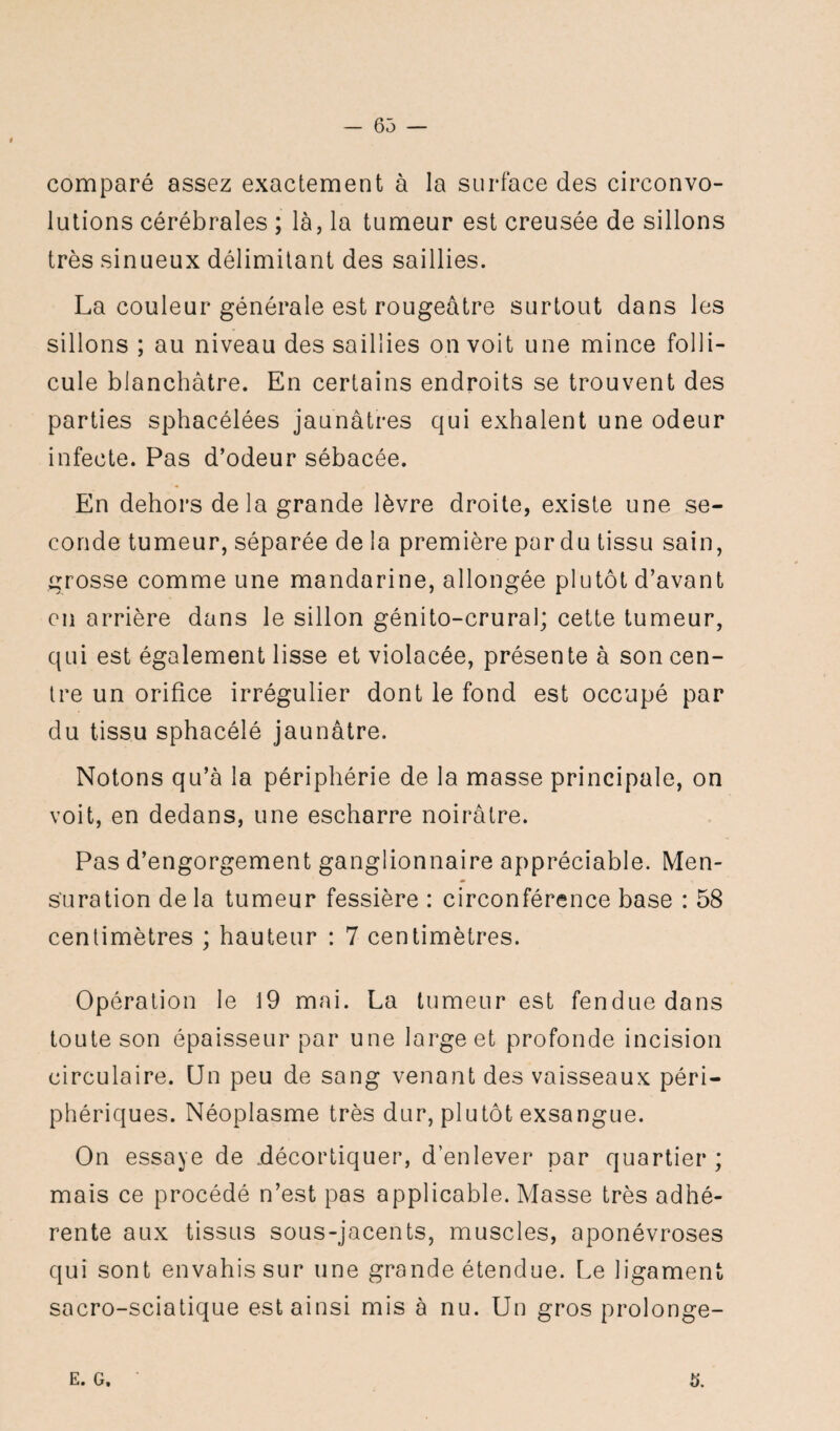 comparé assez exactement à la surface des circonvo¬ lutions cérébrales ; là, la tumeur est creusée de sillons très sinueux délimitant des saillies. La couleur générale est rougeâtre surtout dans les sillons ; au niveau des saillies on voit une mince folli¬ cule blanchâtre. En certains endroits se trouvent des parties sphacélées jaunâtres qui exhalent une odeur infecte. Pas d’odeur sébacée. En dehors delà grande lèvre droite, existe une se¬ conde tumeur, séparée de la première par du tissu sain, grosse comme une mandarine, allongée plutôt d’avant en arrière dans le sillon génito-crural; cette tumeur, qui est également lisse et violacée, présente à son cen¬ tre un orifice irrégulier dont le fond est occupé par du tissu sphacélé jaunâtre. Notons qu’à la périphérie de la masse principale, on voit, en dedans, une escharre noirâtre. Pas d’engorgement ganglionnaire appréciable. Men¬ suration delà tumeur fessière : circonférence base : 58 centimètres ; hauteur : 7 centimètres. Opération le 19 mai. La tumeur est fendue dans toute son épaisseur par une large et profonde incision circulaire. Un peu de sang venant des vaisseaux péri¬ phériques. Néoplasme très dur, plutôt exsangue. On essaye de décortiquer, d’enlever par quartier; mais ce procédé n’est pas applicable. Masse très adhé¬ rente aux tissus sous-jacents, muscles, aponévroses qui sont envahis sur une grande étendue. Le ligament sacro-sciatique est ainsi mis à nu. Un gros prolonge- E. G. 5.