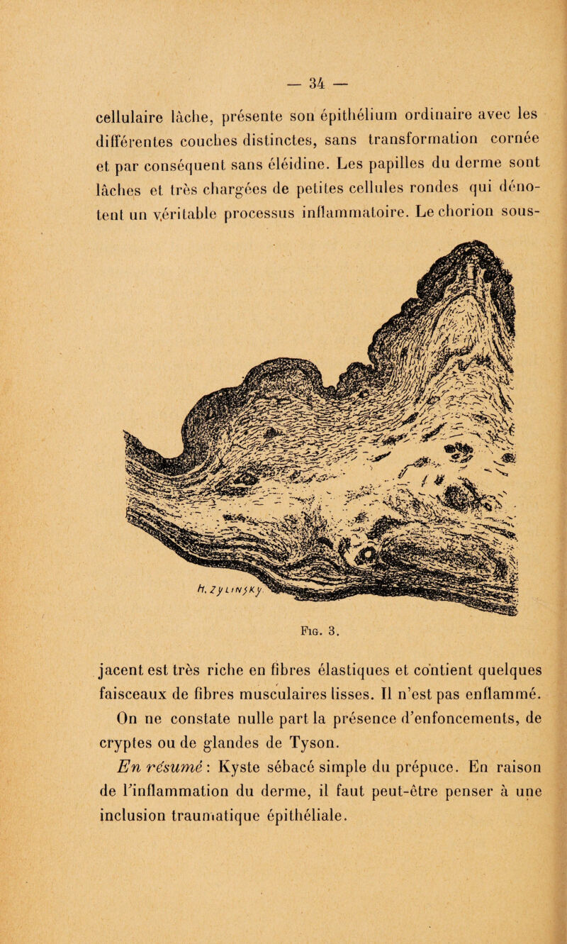 cellulaire lâche, présente son épithélium ordinaire avec les différentes couches distinctes, sans transformation cornée et par conséquent sans éléidine. Les papilles du derme sont lâches et très chargées de petites cellules rondes qui déno¬ tent un véritable processus inflammatoire. Le chorion sous- jacent est très riche en fibres élastiques et contient quelques faisceaux de fibres musculaires lisses. Il n’est pas enflammé. On ne constate nulle part la présence d’enfoncements, de cryptes ou de glandes de Tyson. En résumé : Kyste sébacé simple du prépuce. En raison de l’inflammation du derme, il faut peut-être penser à une inclusion traumatique épithéliale.